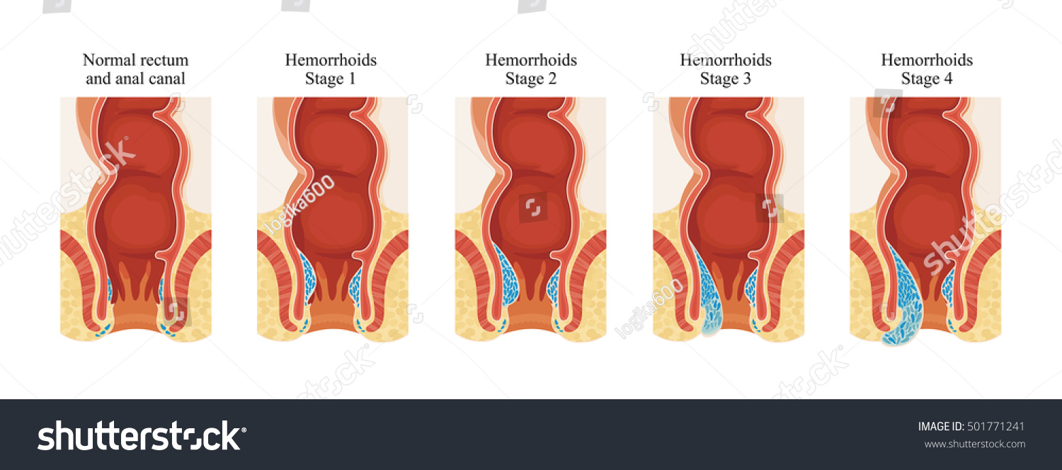 Hemorrhoids Stage. Stock Photo 501771241 : Shutterstock