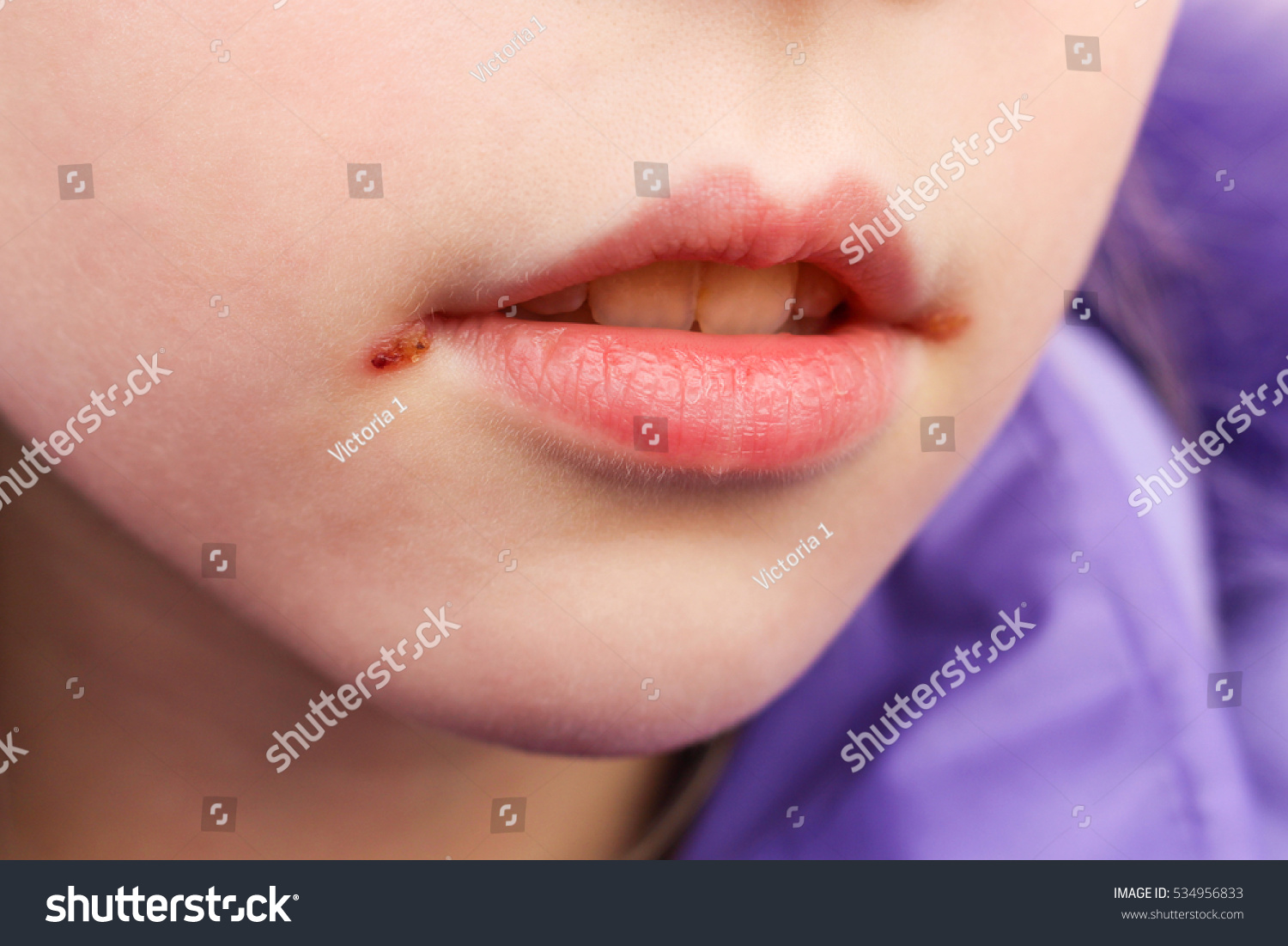 子の唇のヘルペス の写真素材 今すぐ編集