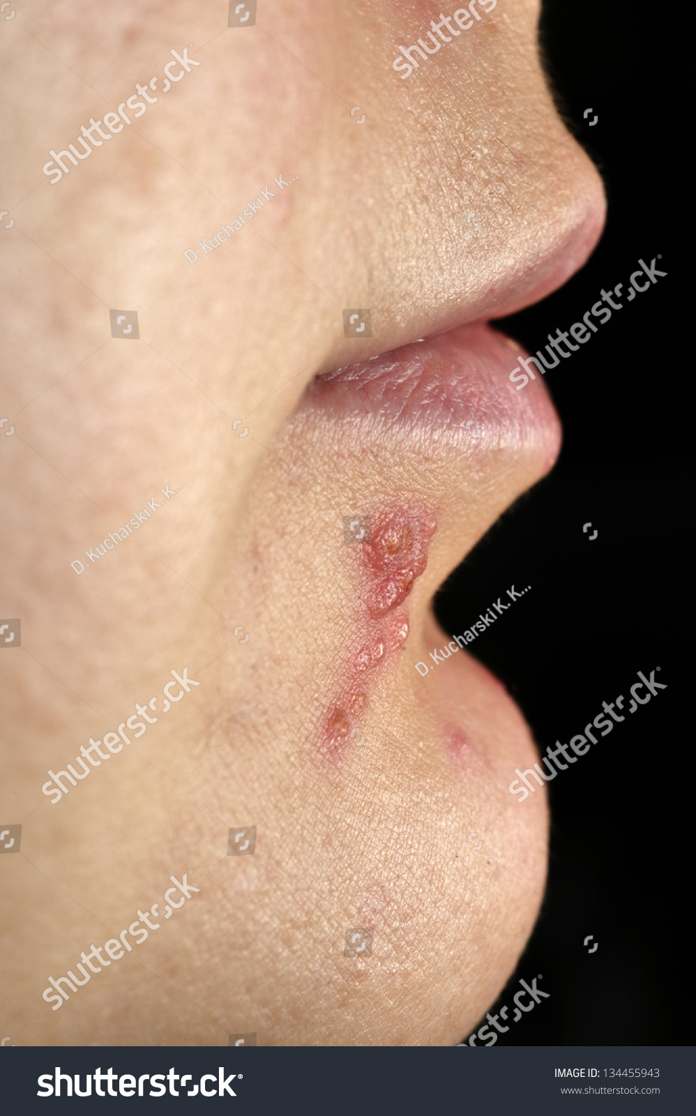 herpes simplex nose pictures