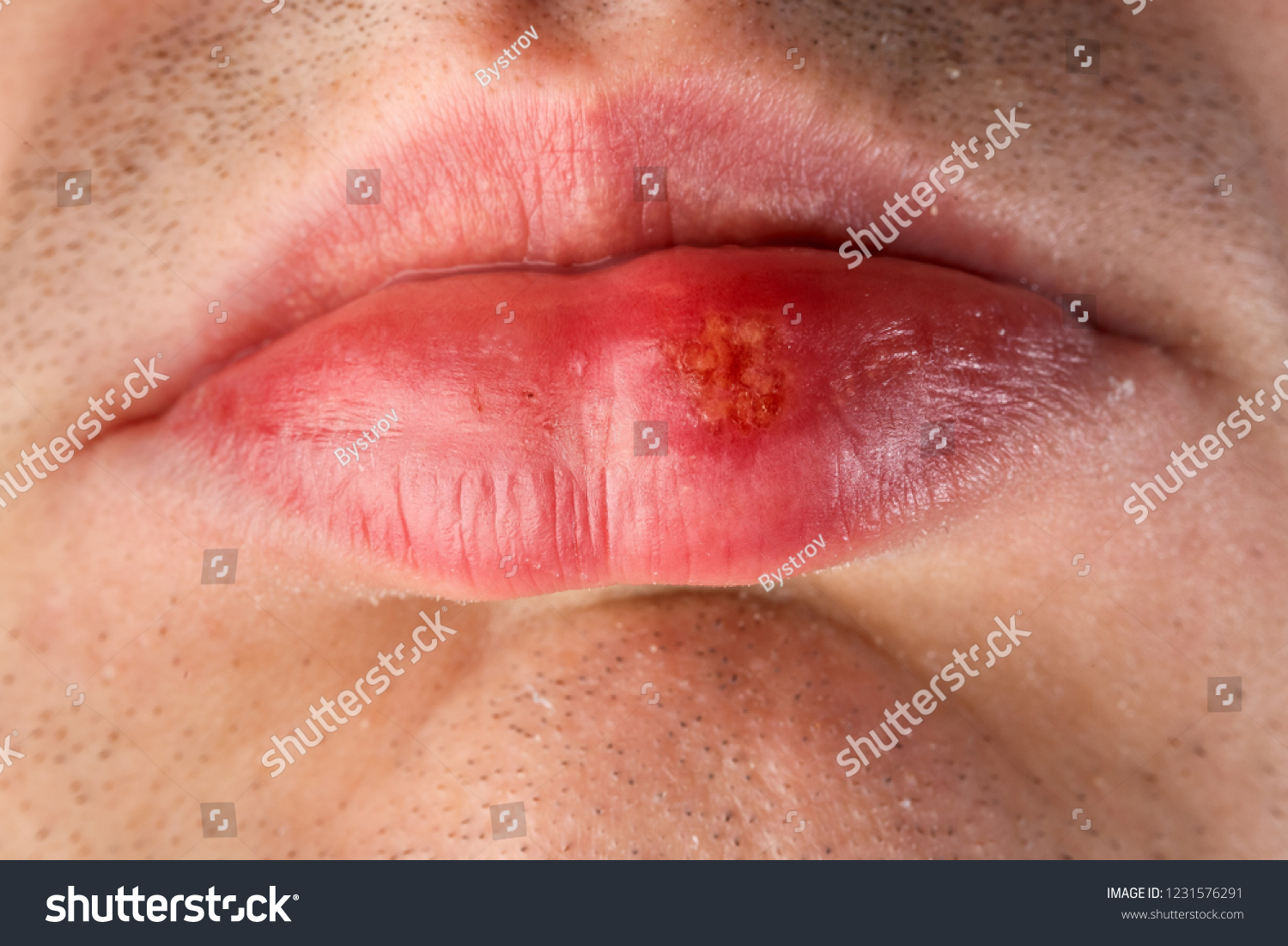 Herpes a virus is what Herpesviridae