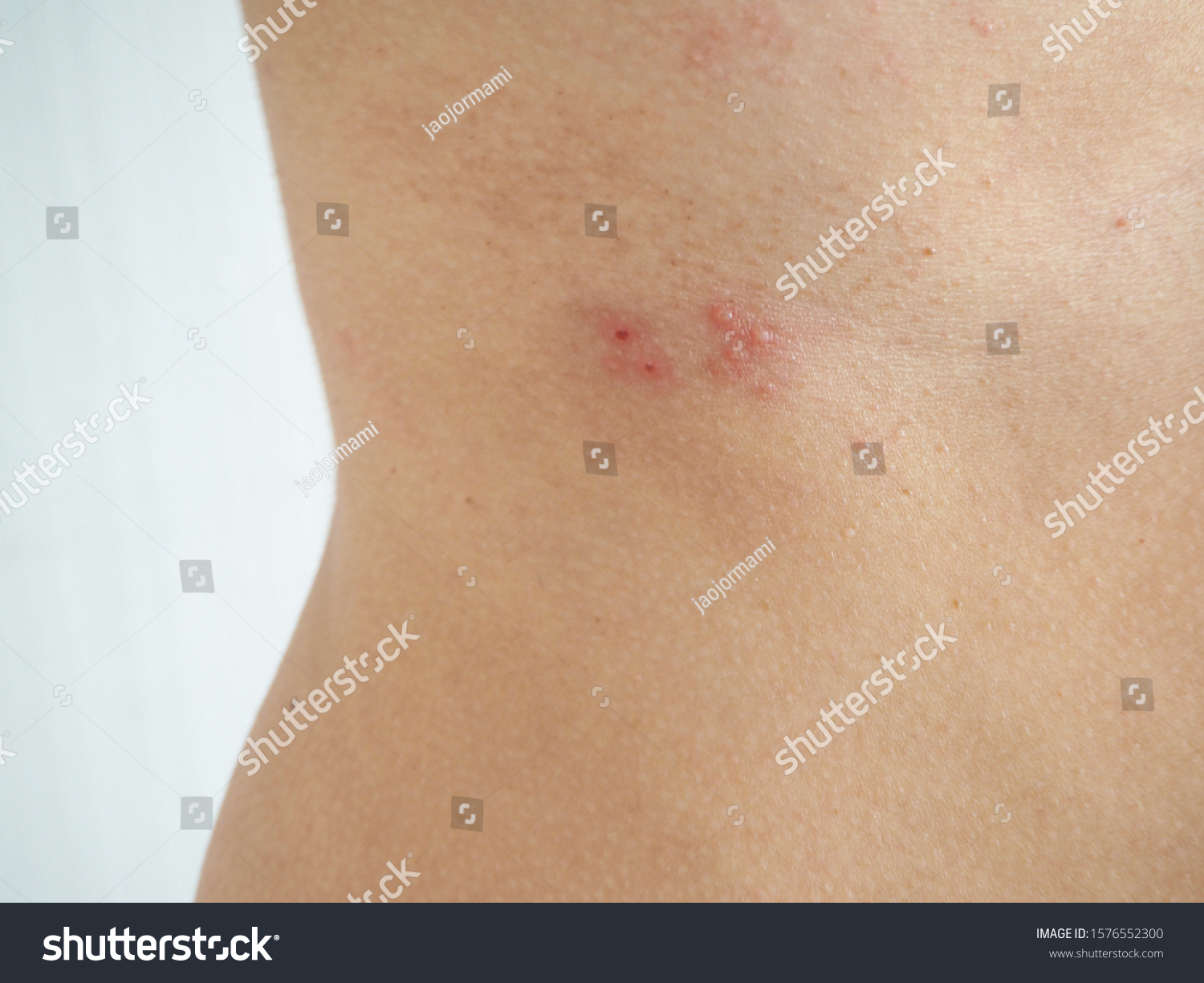 Herpes Zoster Shingles Woman On Her写真素材1576552300 Shutterstock 