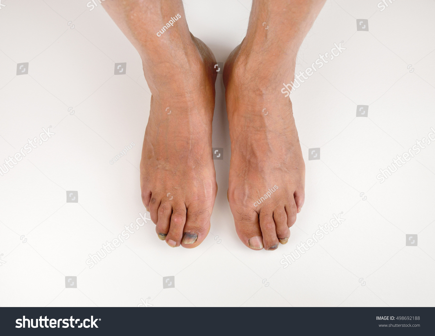 High Angle Shot Two Feet Subungual Stock Photo 498692188 - Shutterstock