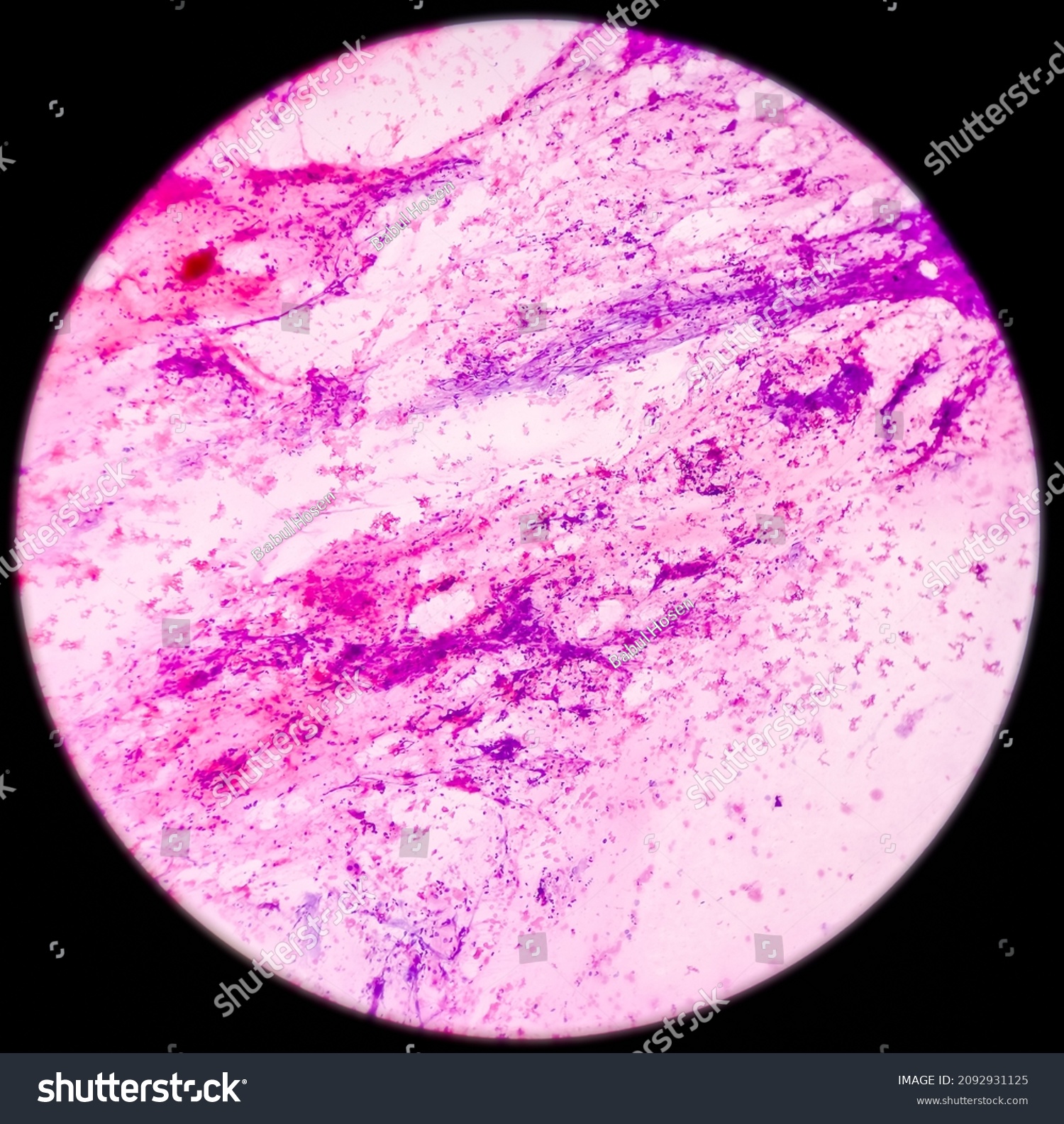 High Grade Squamous Intraepithelial Lesionhsil Photomicrograph Stock