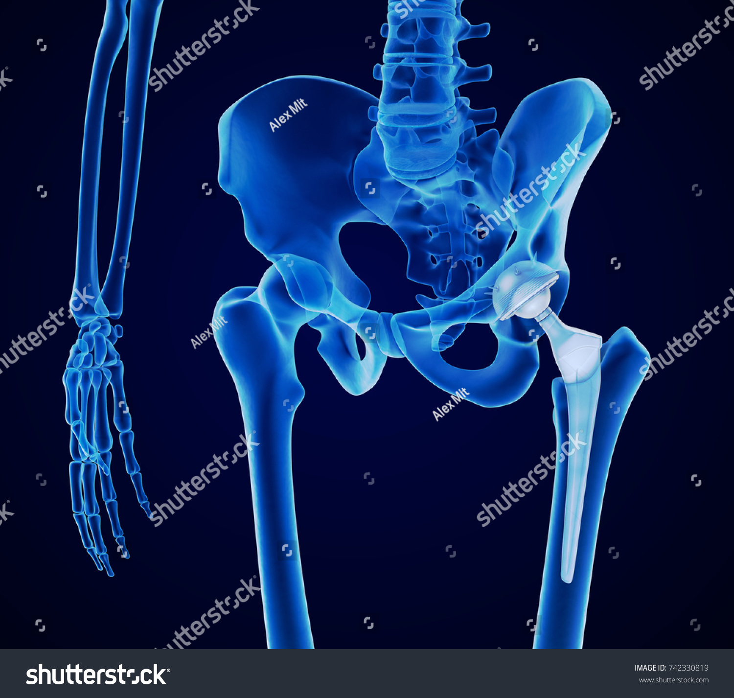 hip-replacement-implant-installed-pelvis-bone-stock-illustration-742330819