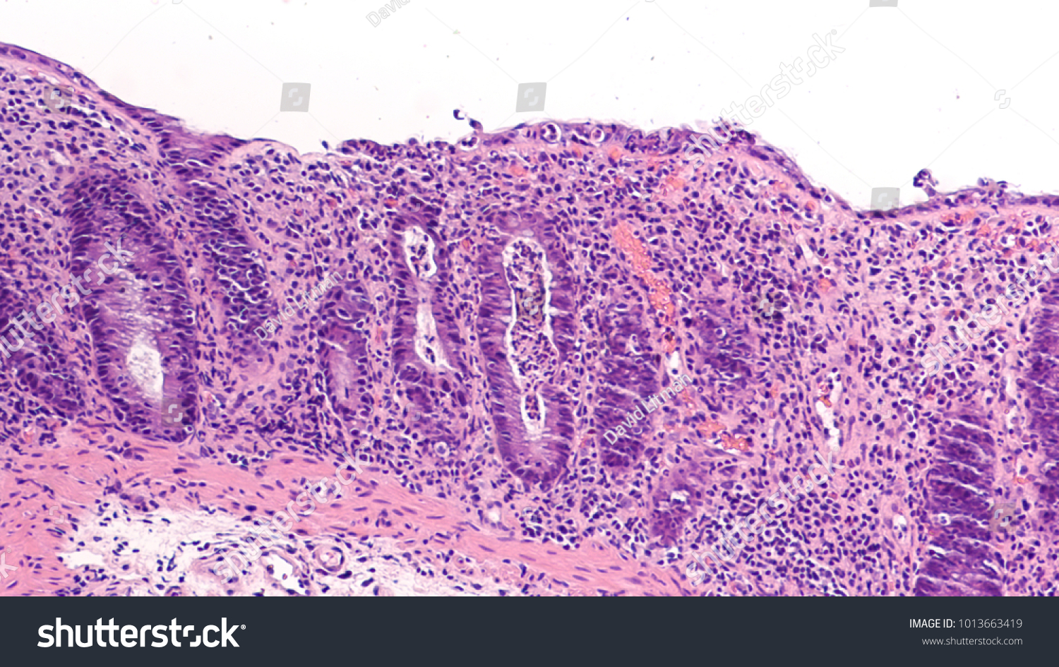 急性 活性 陰窩炎や陰窩膿瘍などの慢性潰瘍性大腸炎 炎症性腸疾患の一種 Ibd の変化を結腸鏡検査で示す生検の組織学的な部分 の写真素材 今すぐ編集