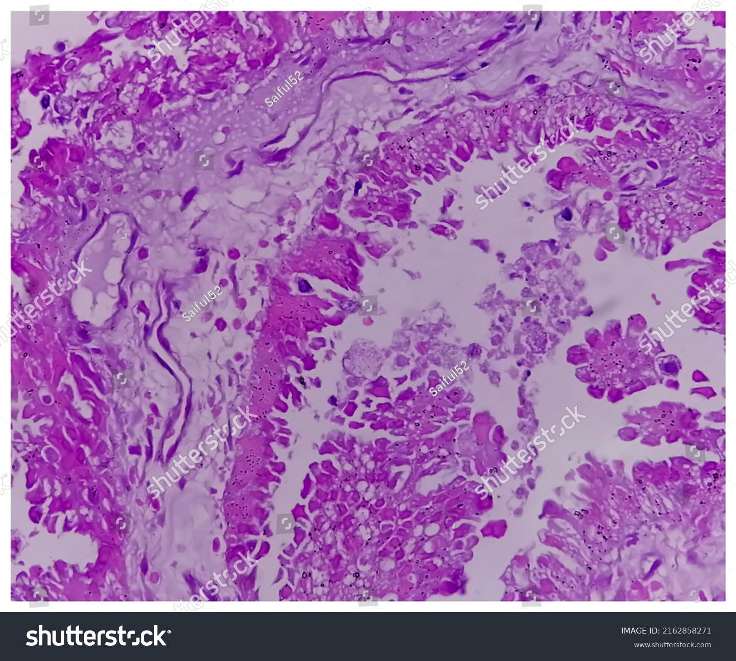 Histology Metastatic Papillary Adenocarcinoma Stock Photo 2162858271 ...