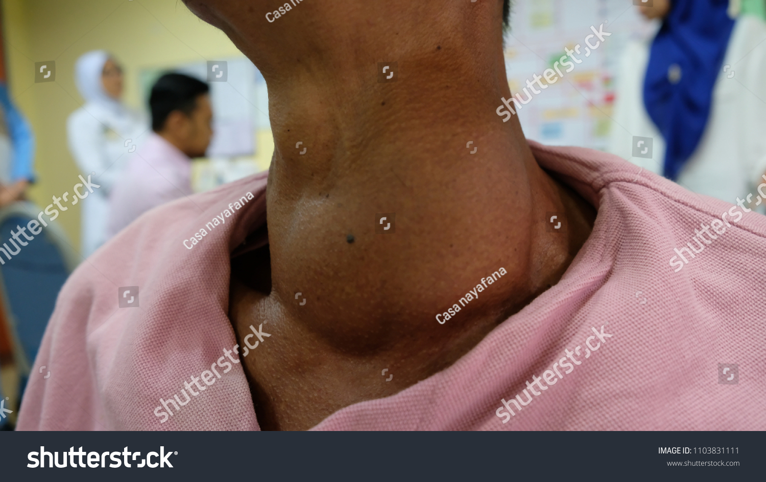 Huge Anterior Neck Swelling Left Thyroid Stock Photo Edit Now 1103831111