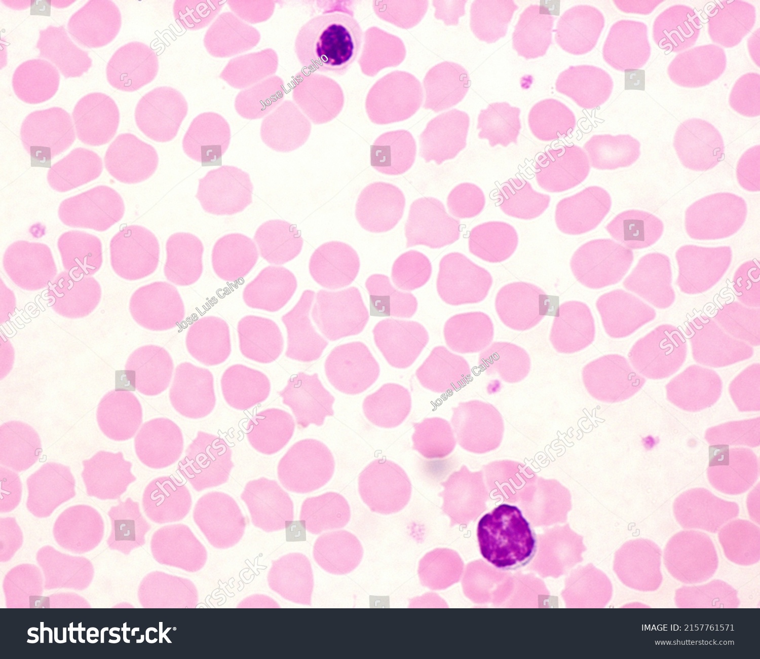 Human Blood Smear Showing Lymphocyte Bottom Stock Photo 2157761571 ...