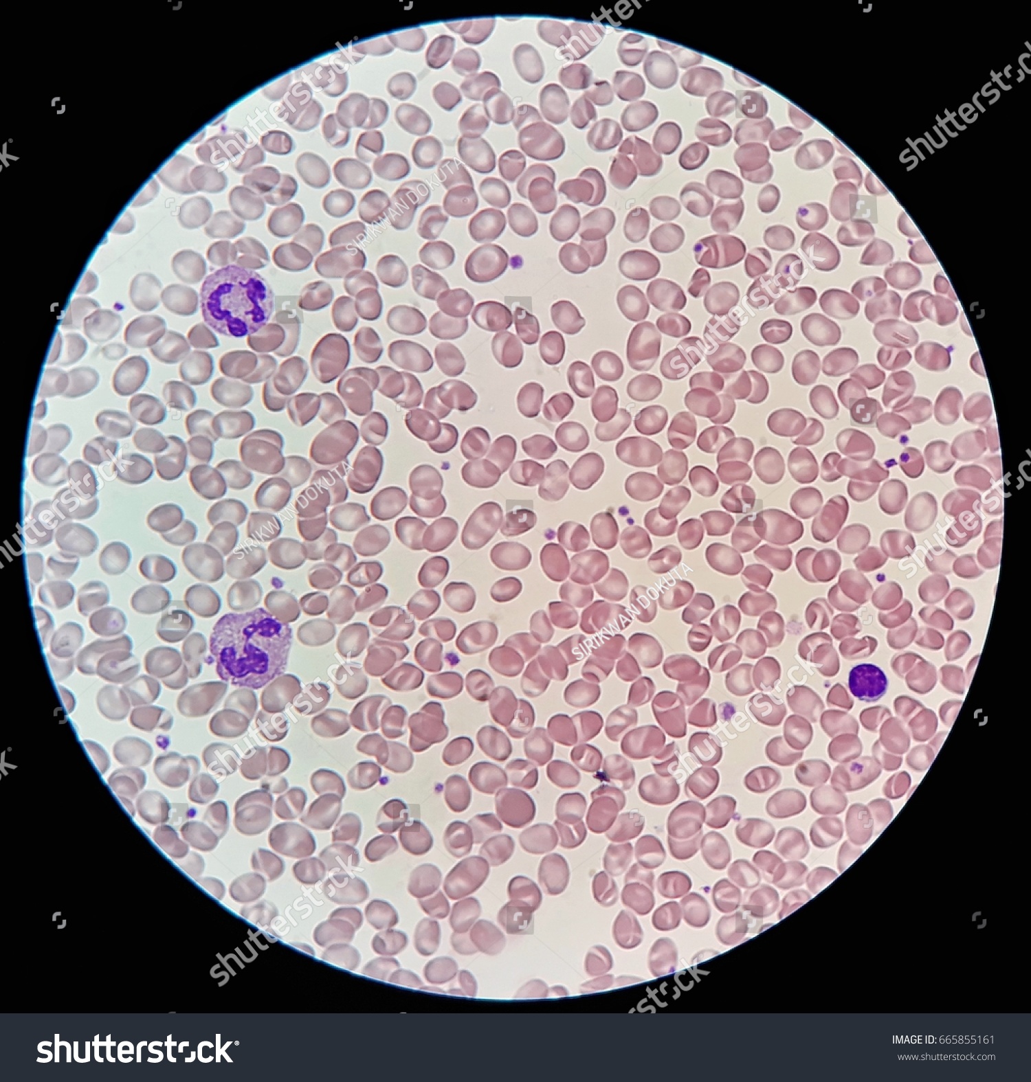 Human Blood Smear Abnormal Red Blood Stock Photo 665855161 - Shutterstock