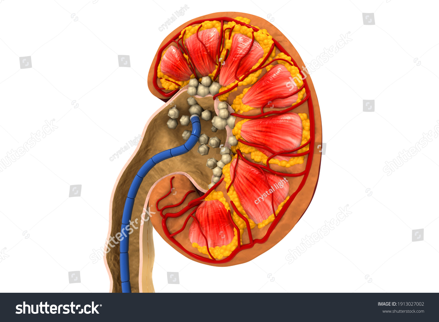 ureterolithiasis single stone in the left ureter with hydronephrosis icd 10