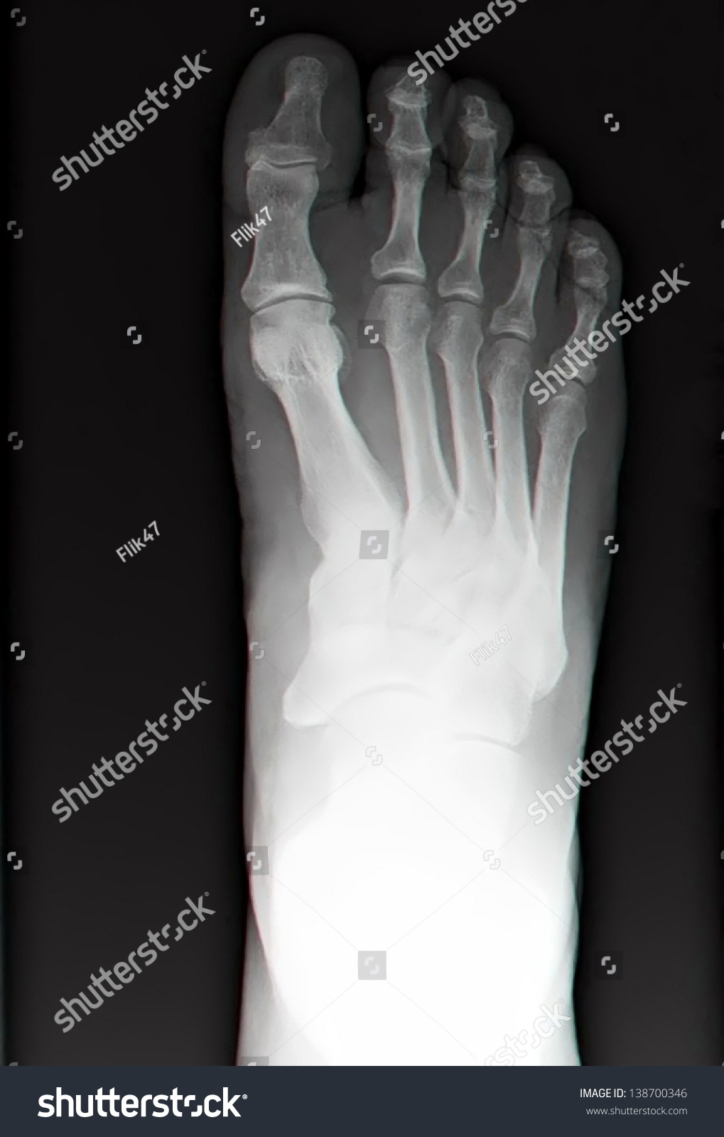 Human Leg Bone X-Rays Stock Photo 138700346 : Shutterstock