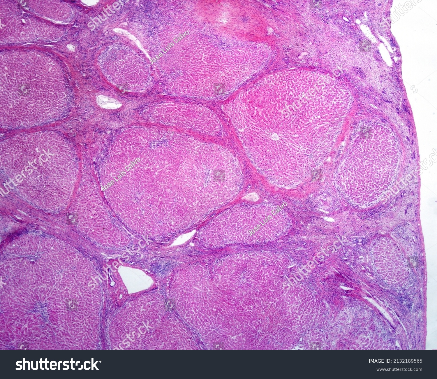 human-liver-cirrhosis-microscopically-main-features-stock-photo