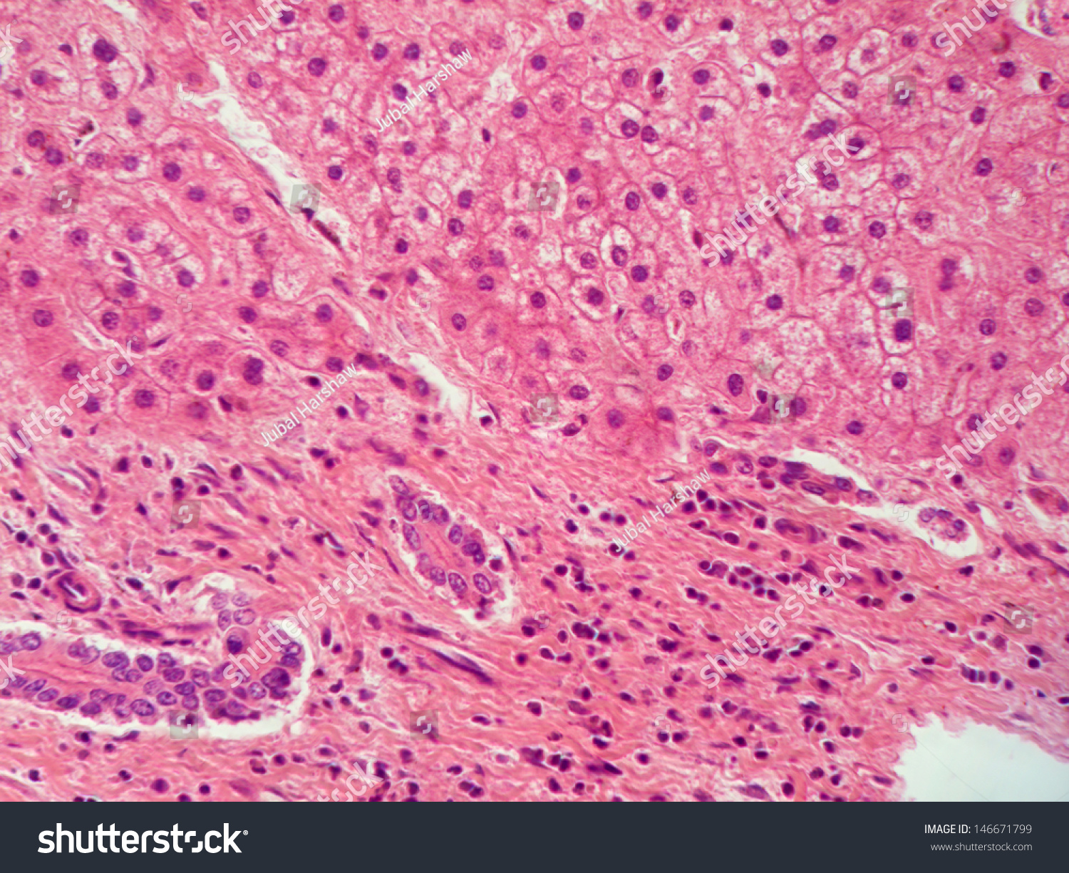 Human Liver Cirrhosis Showing Hepatocytes Top Stock Photo 146671799 ...