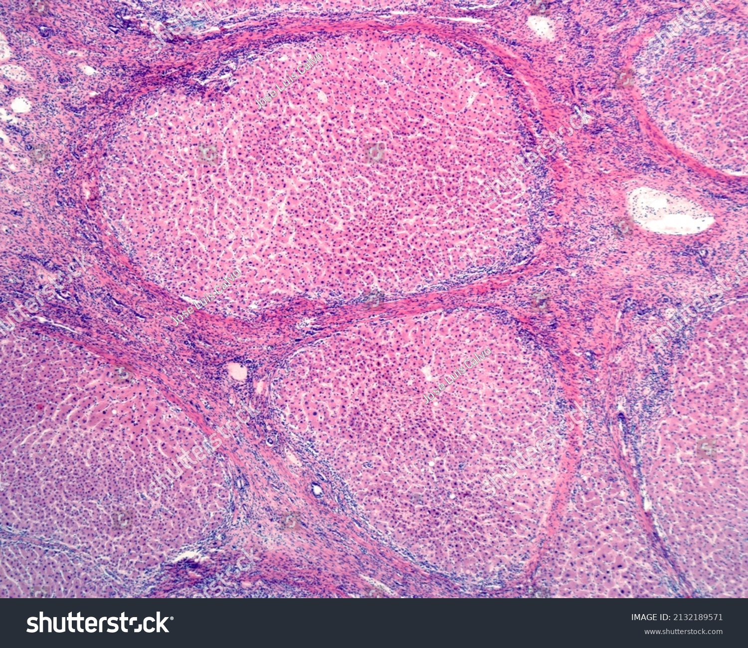 Human Liver Cirrhosis Micrograph Shows Two Stock Photo (Edit Now ...