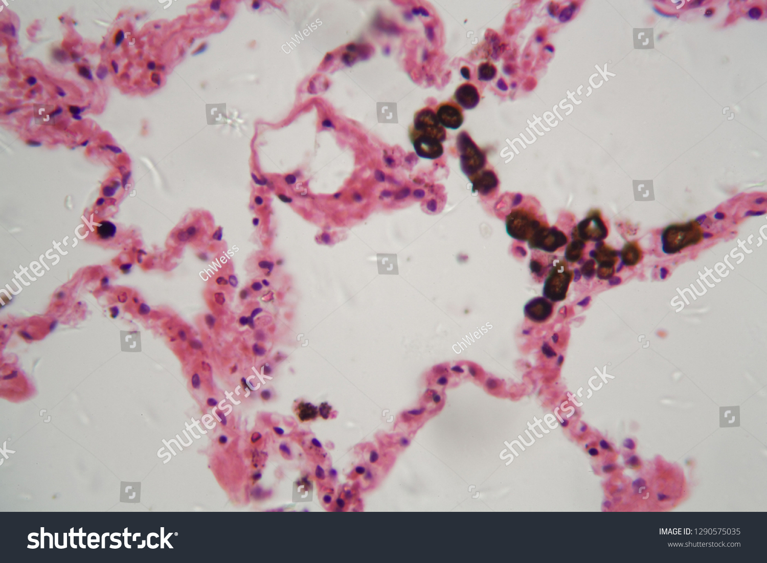 Human Lung Tissue Dust Coal Particles Stock Photo (Edit Now) 1290575035