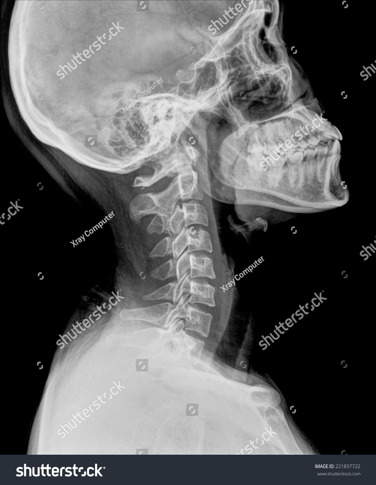 Human Neck Radiography Side View Stock Photo 221837722 - Shutterstock