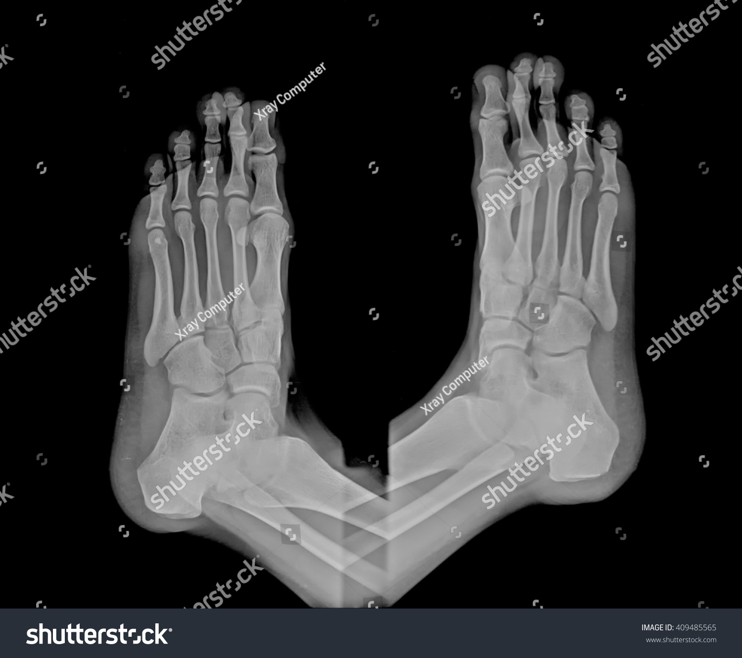 Human Right Left Foot Ankle Xray Stock Photo 409485565 | Shutterstock