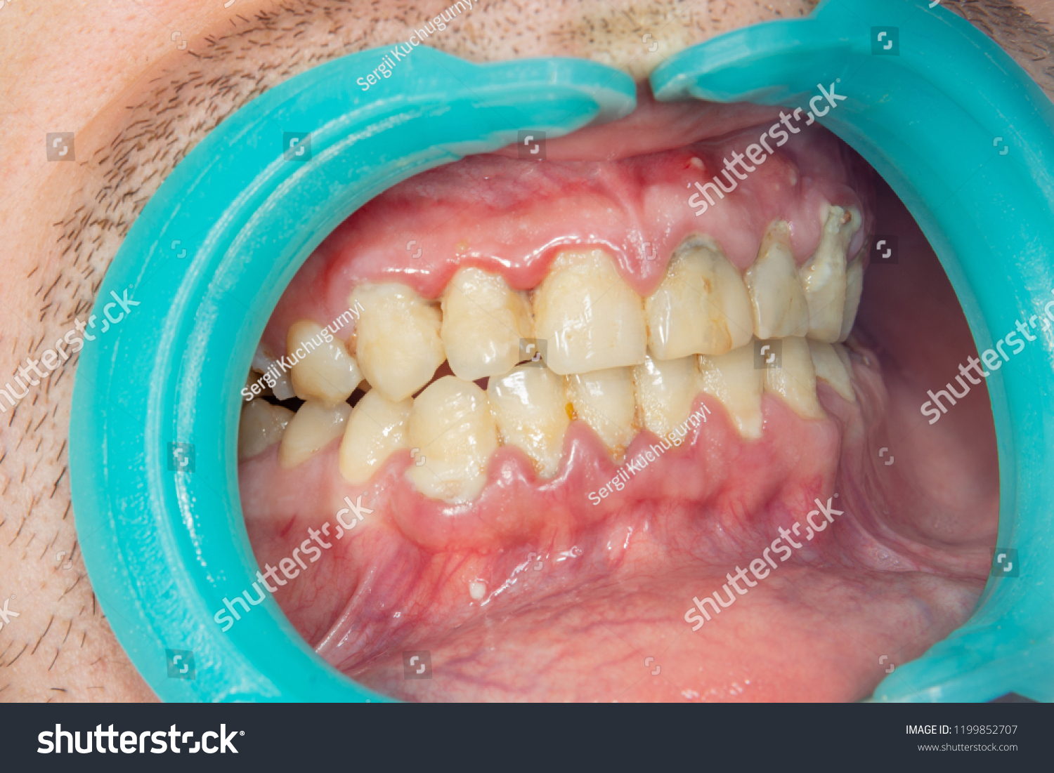 Human Teeth Closeup Dental Plaque Inflammation Stock Photo 1199852707 ...