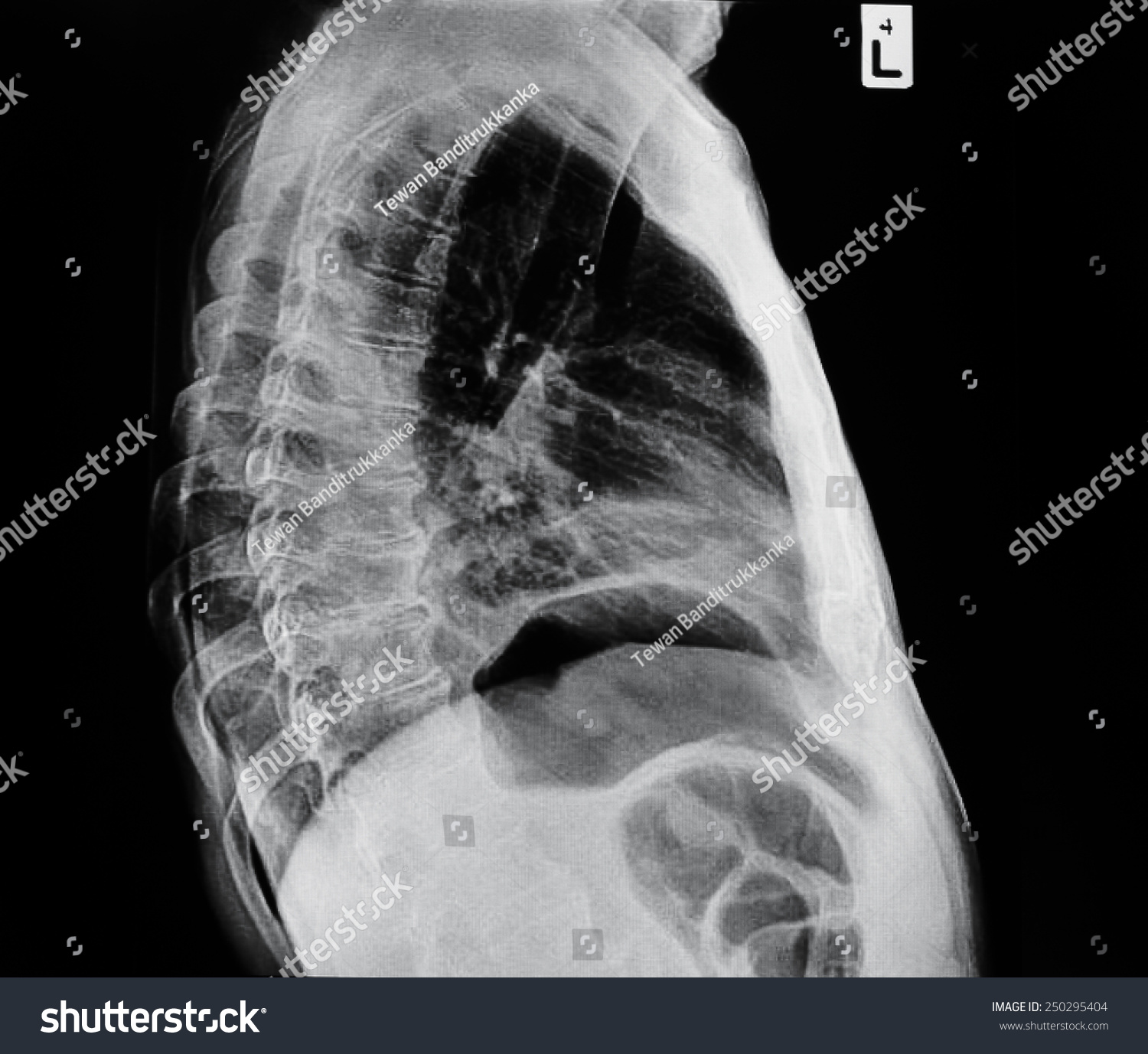 Human Thorax Radiography Side View Chest Stock Photo Edit Now