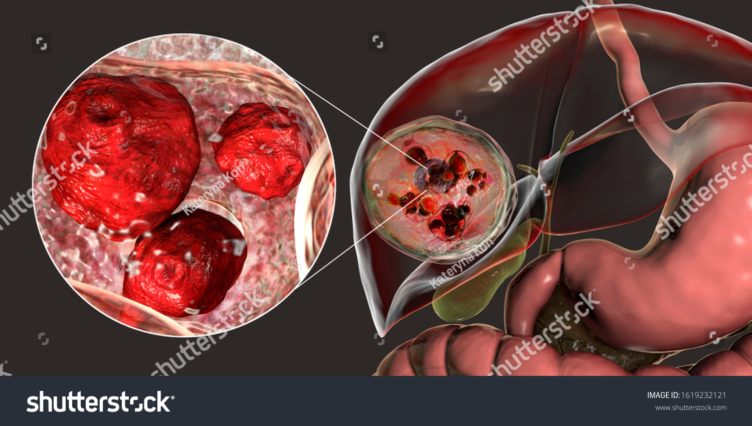 Hydatid Cyst Echinococcus Granulosus Liver 3d Stock Illustration ...