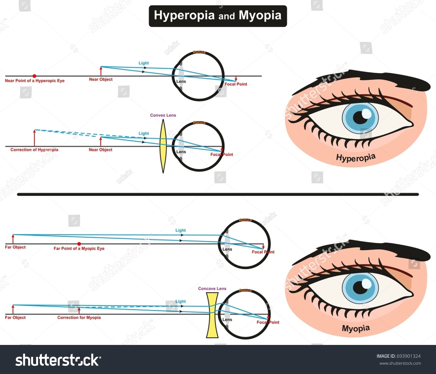Hyperopia Myopia Infographic Diagram Showing Comparison