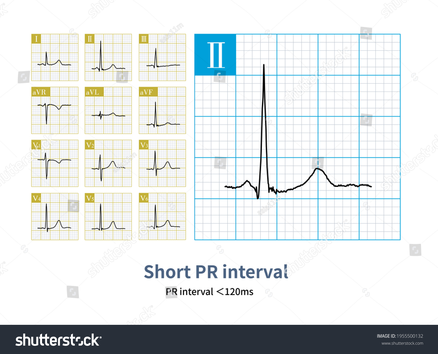 Pr Interval Ecg Shortened There History Stock Illustration 1955500132 