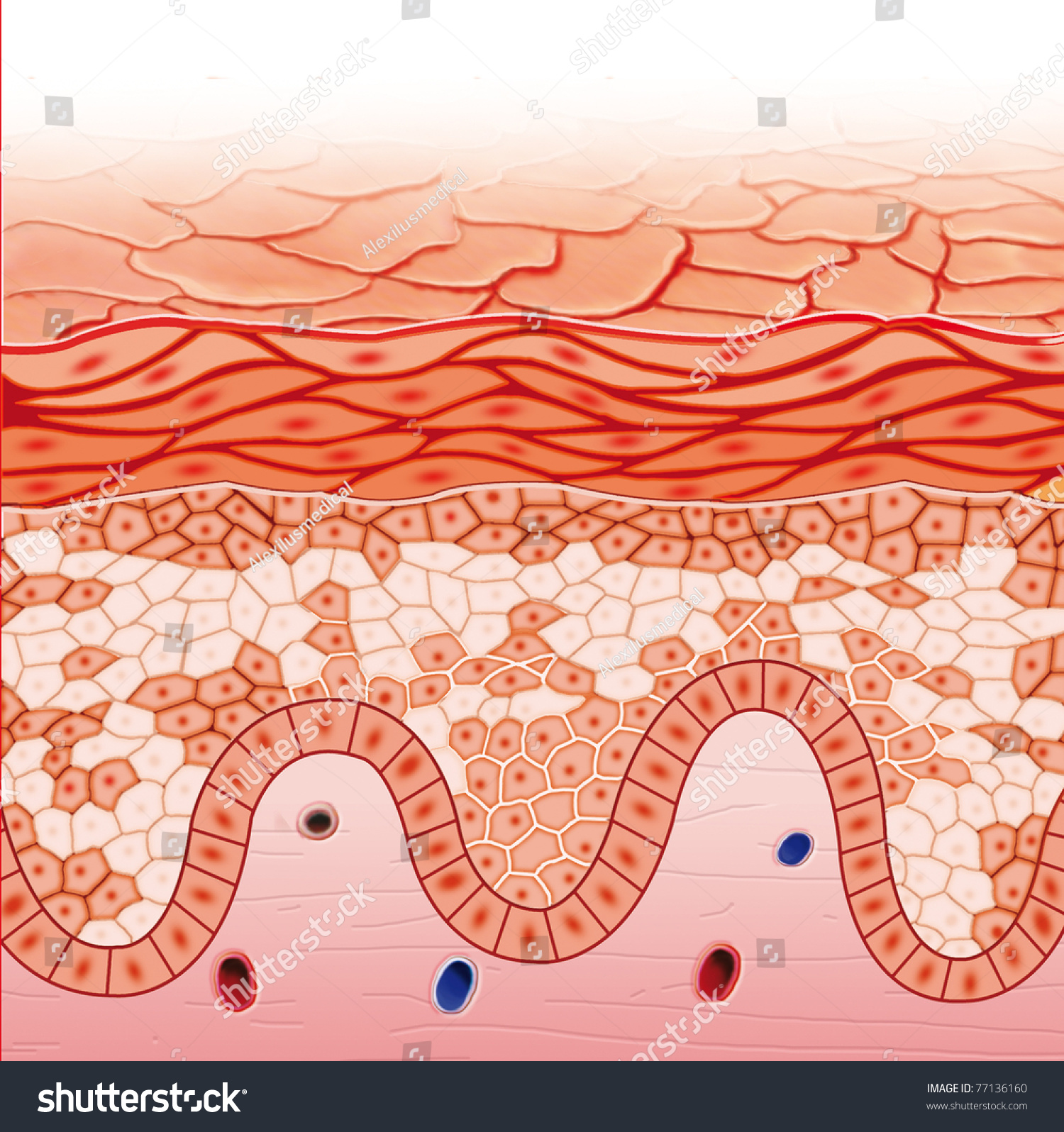 Illustration Of Darier'S Disease Skin - 77136160 : Shutterstock