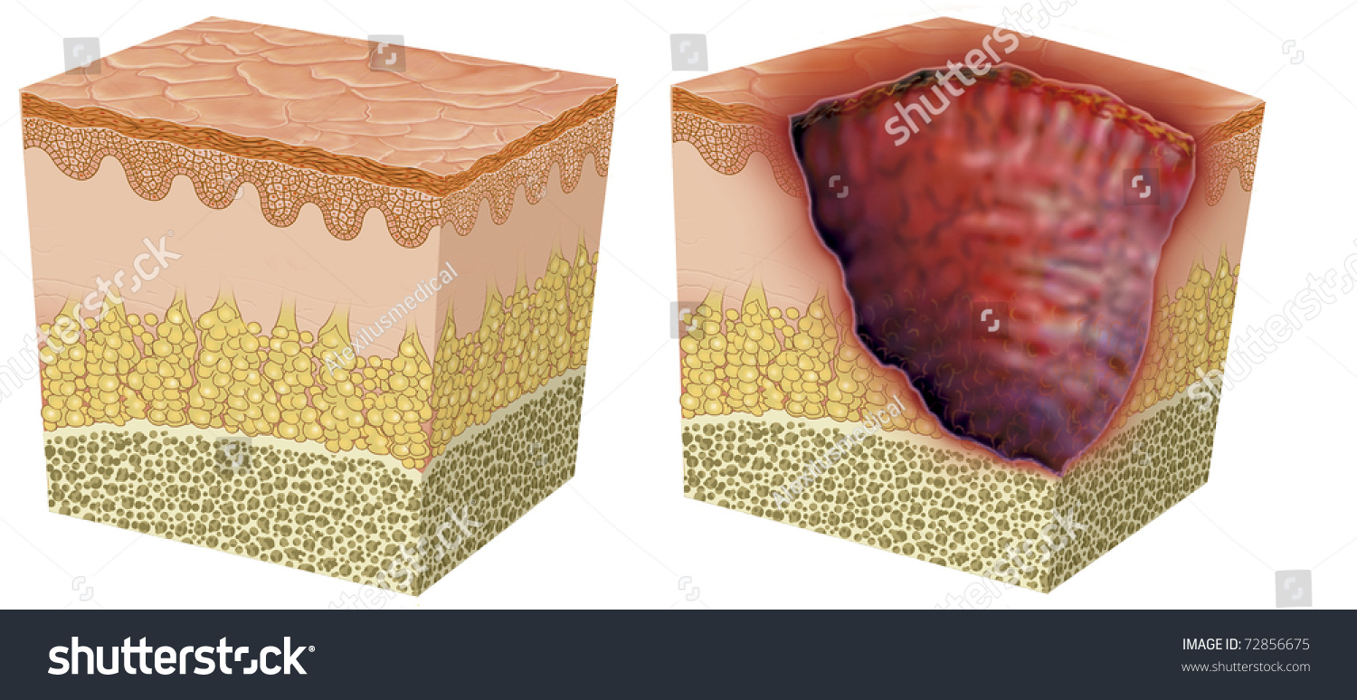 Illustration Skin Ulceration Stock Illustration 72856675