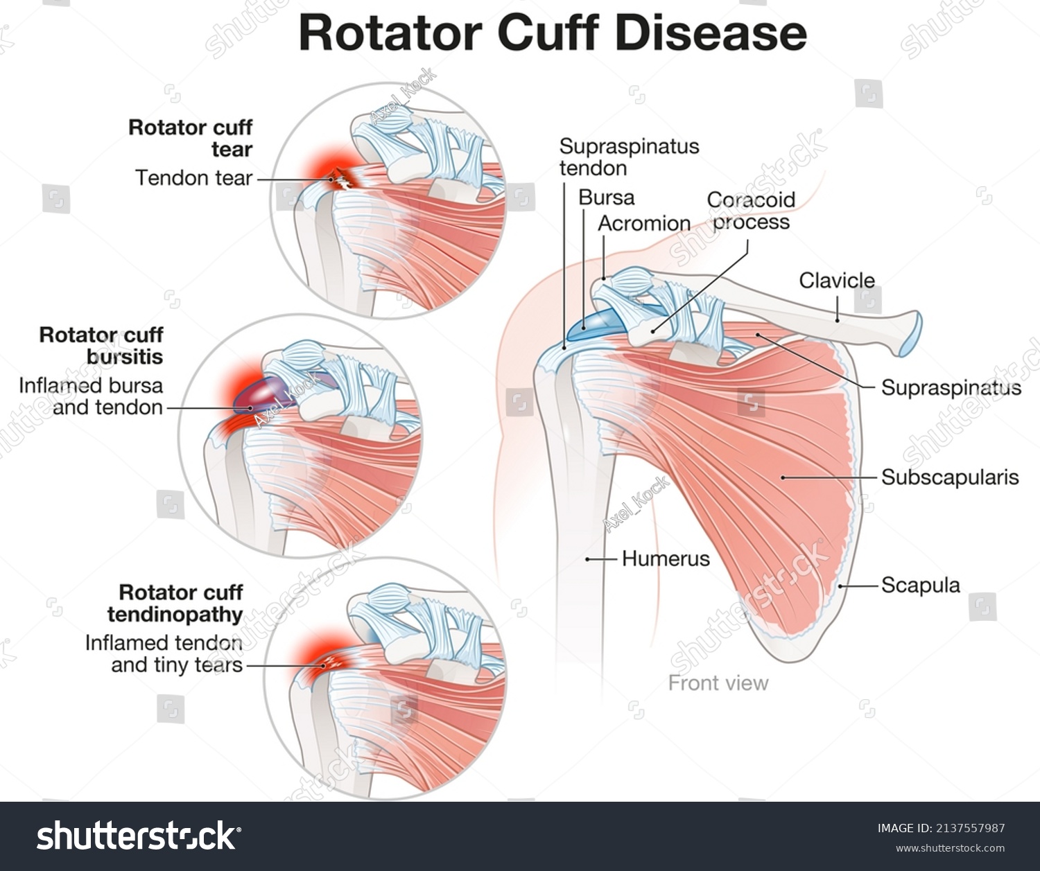 Illustration Showing Shoulder Rotator Cuff Disease Stock Illustration ...