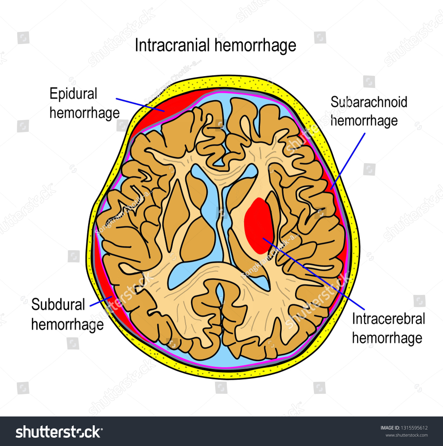 Stock Ilustrace „illustration Shown Many Types Intracranial Hemorrhage“ 1315595612 Shutterstock 8792