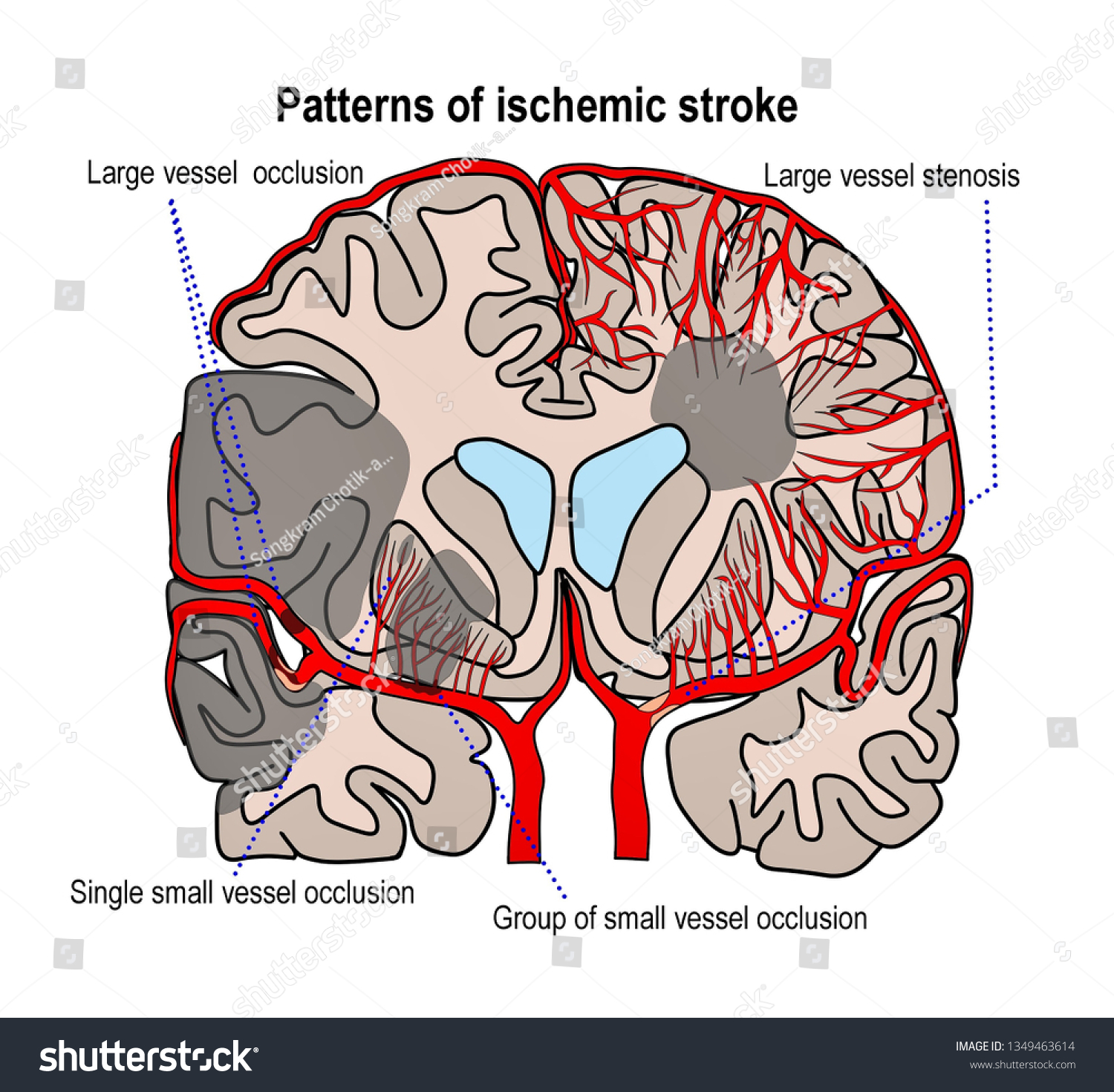 Illustration Shown Different Patterns Arterial Occlusion ภาพประกอบสต็อก 1349463614 Shutterstock