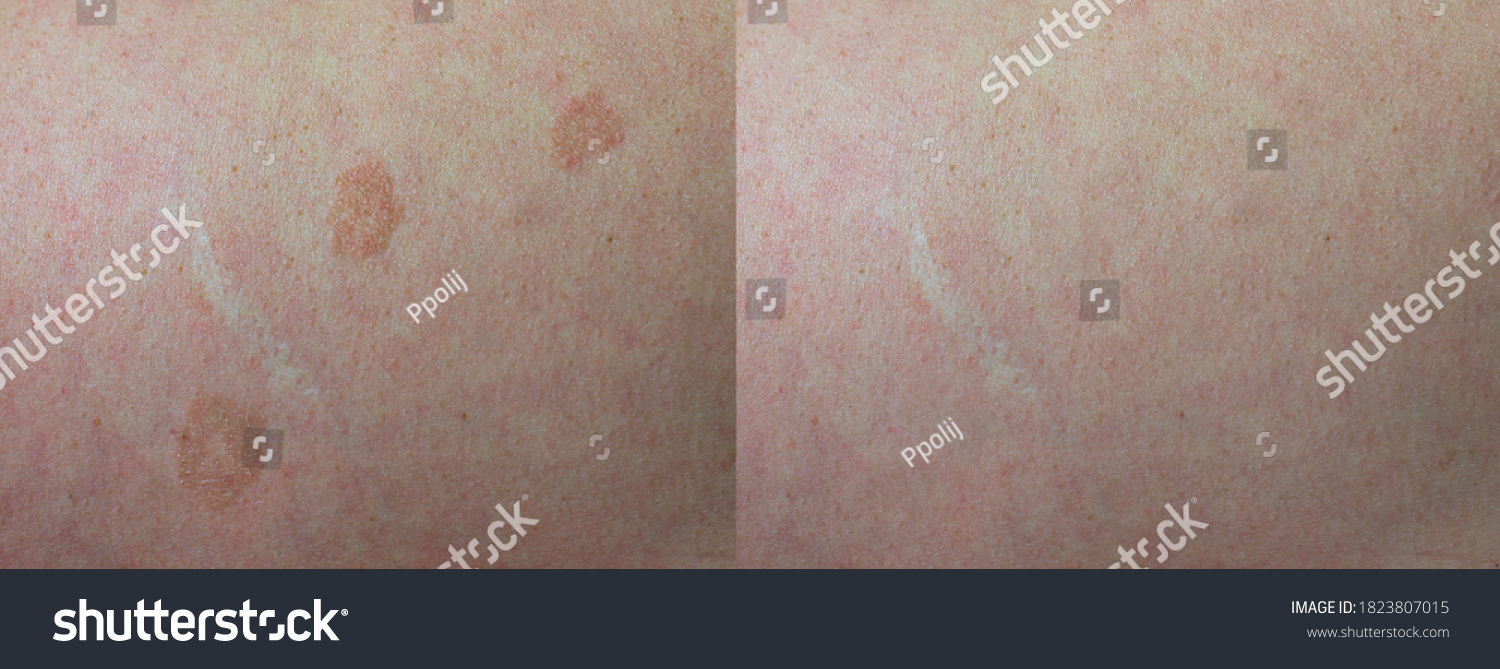 Image Before After Skin Treatment Skin Stock Photo 1823807015 ...