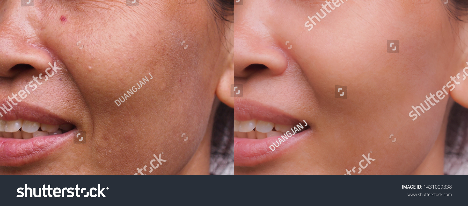 Image Before After Spot Melasma Pigmentation Stock Photo Edit Now