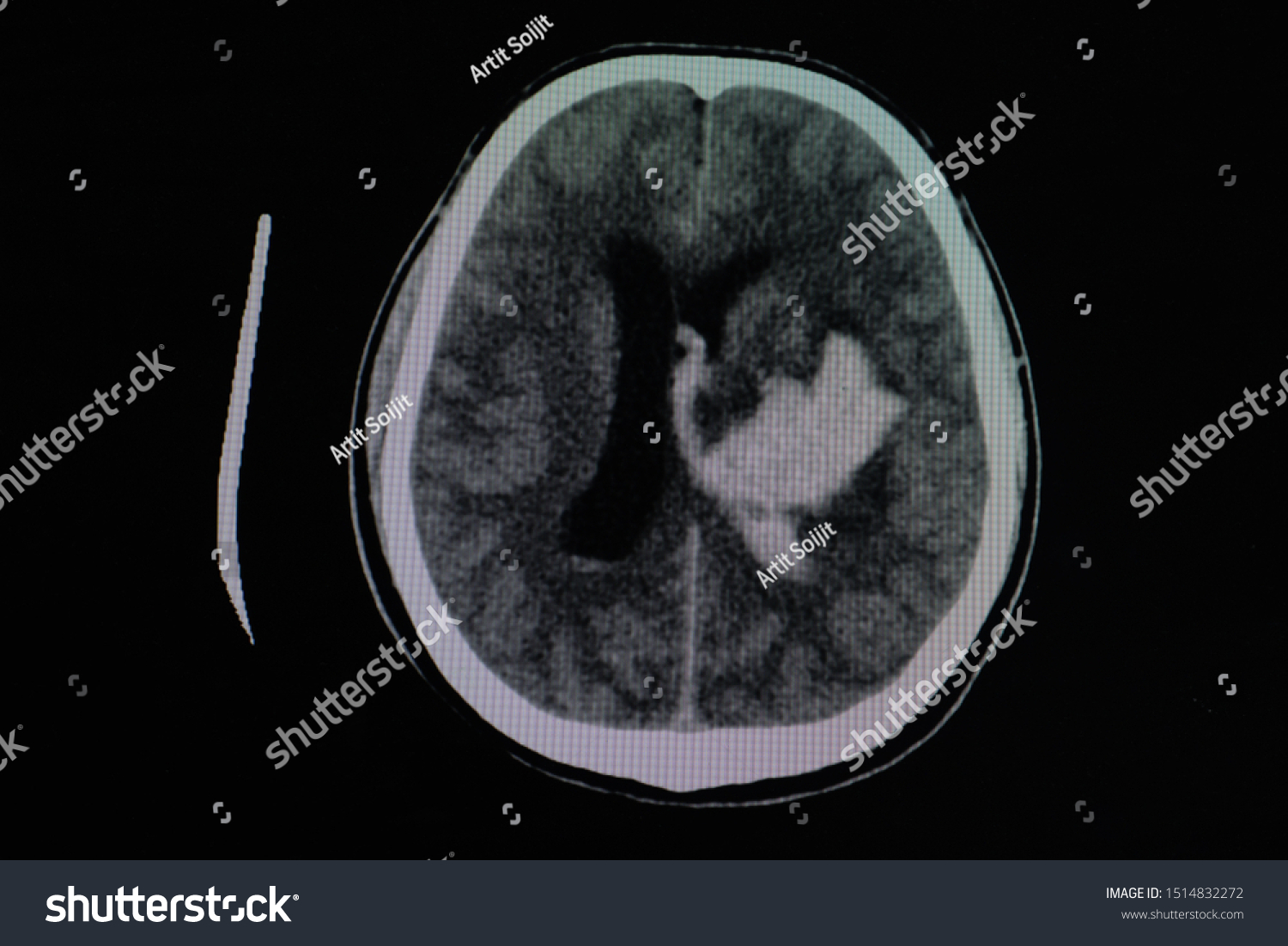 ct scan report of brain stroke