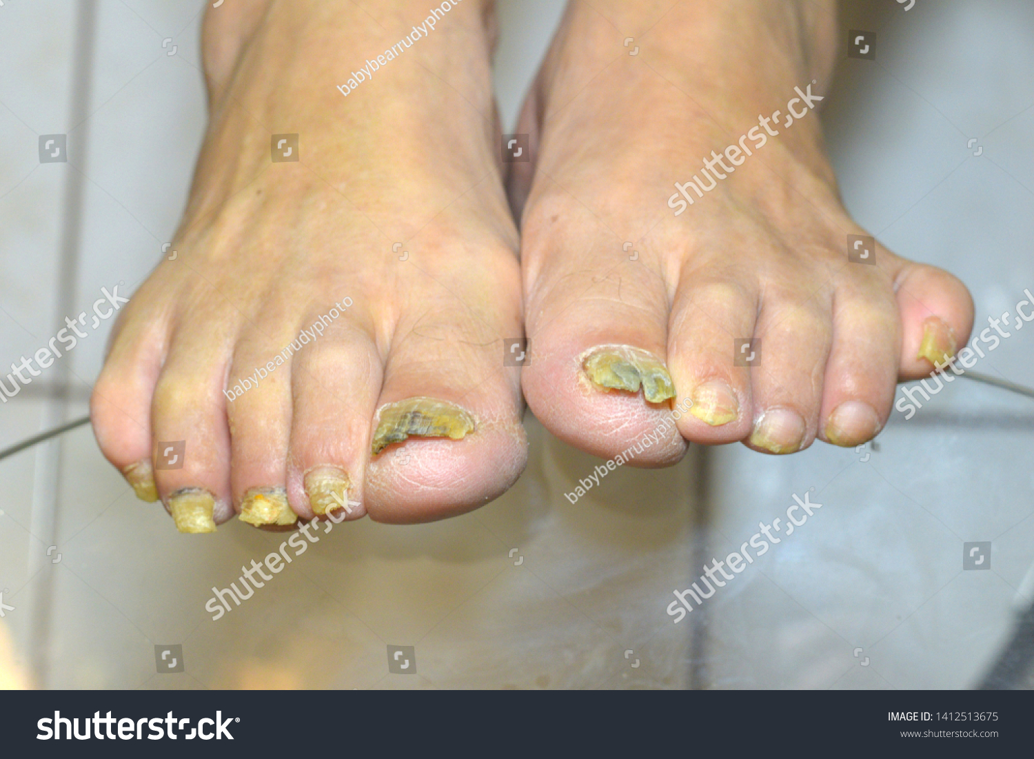 cracked toes fungus
