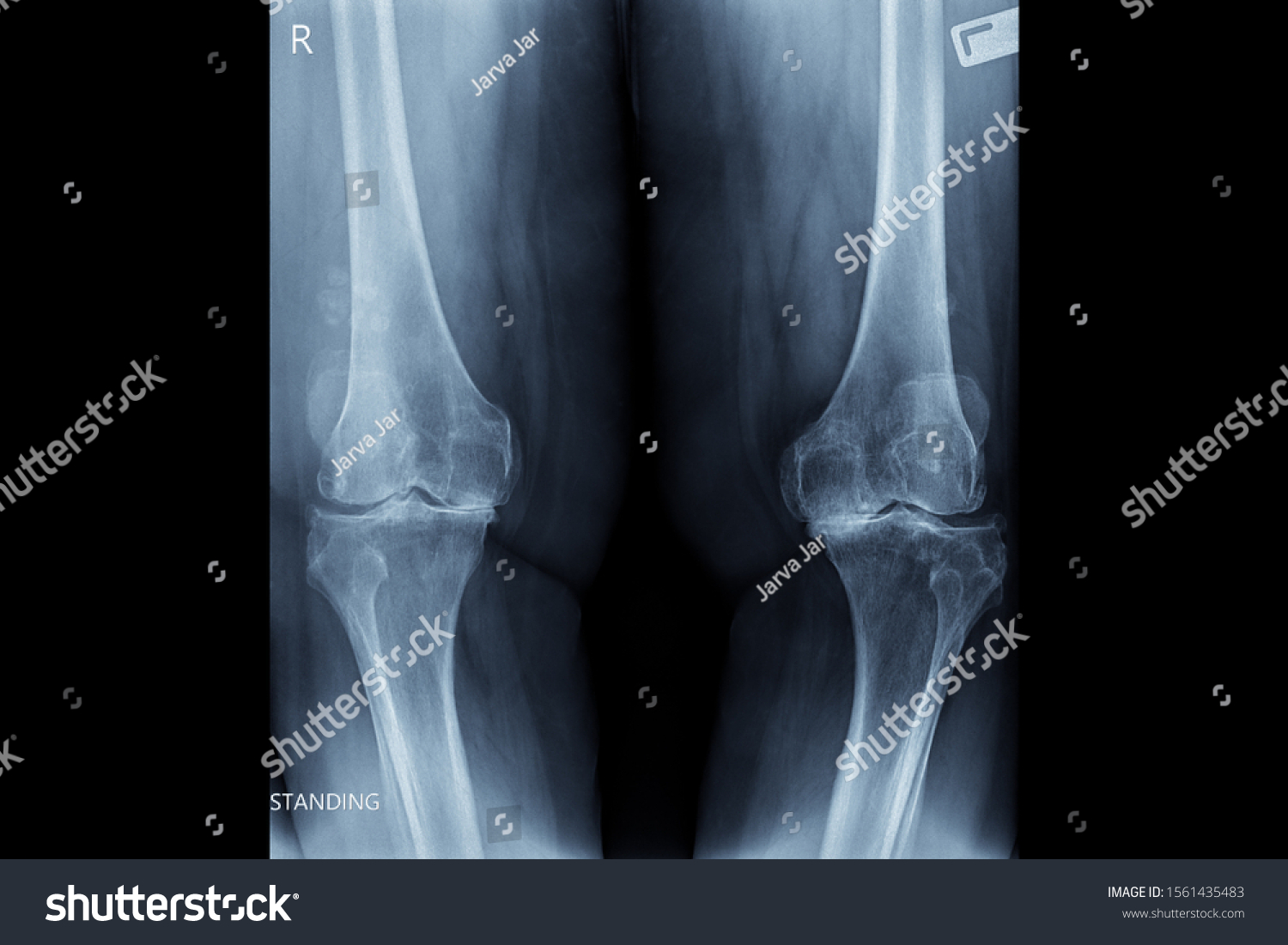 Image Show Xray Both Knee Osteoarthritis Stock Photo (Edit Now) 1561435483