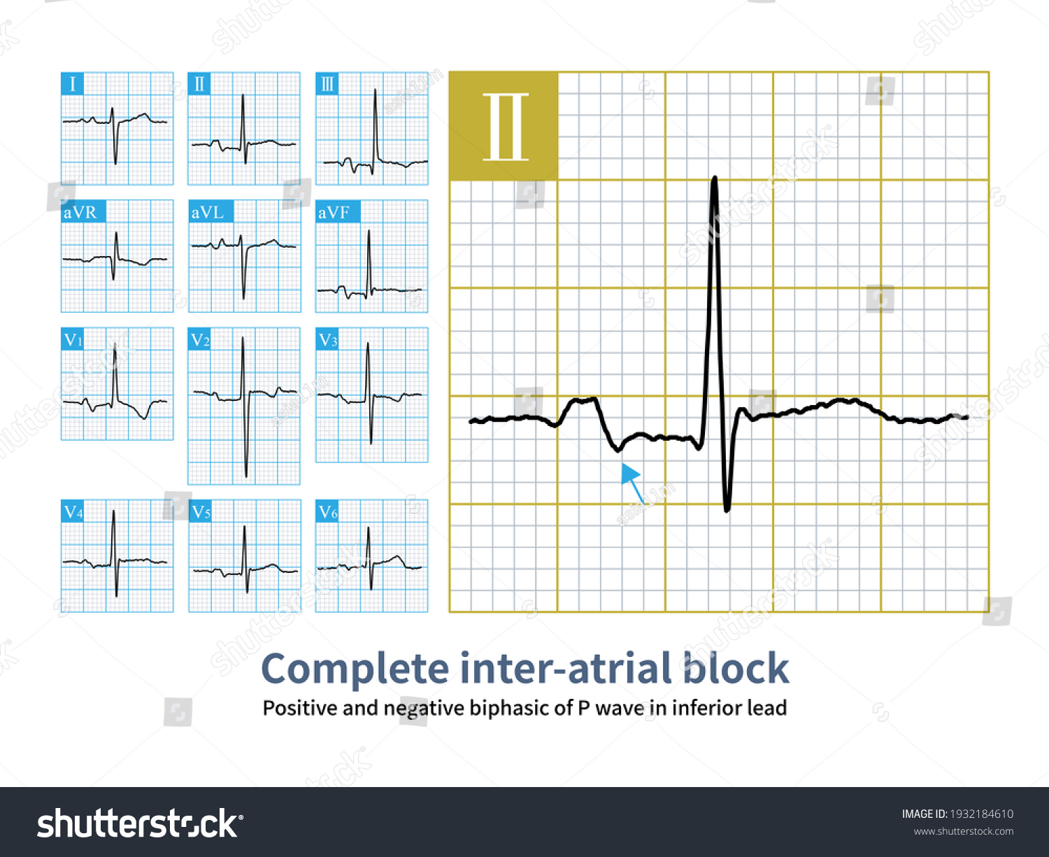 Complete Interatrial Block Left Atrium Activated Stock Illustration ...