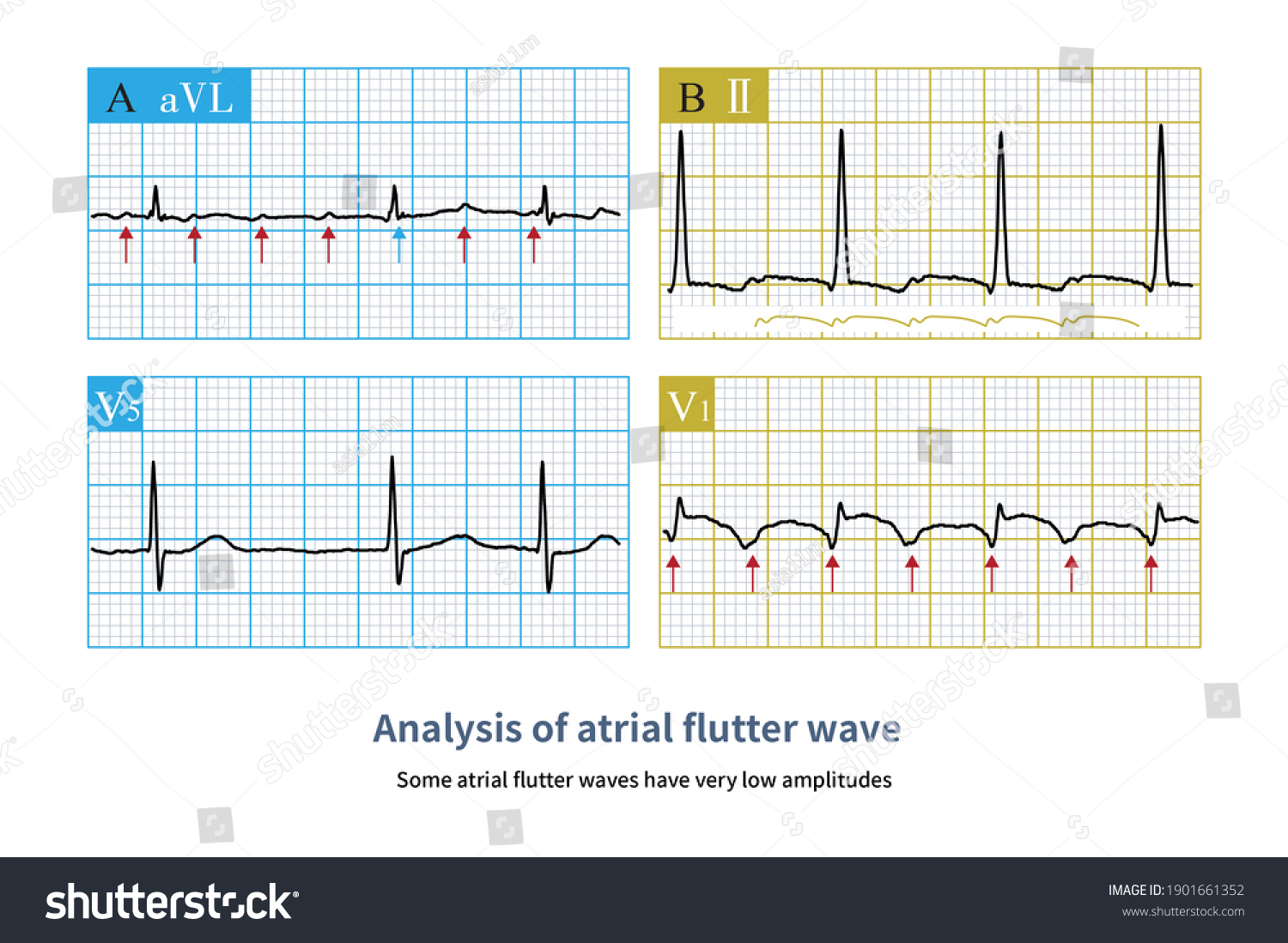 12 Lead Ecg Amplitude Atrial Flutter Illustrazione Stock 1901661352 Shutterstock 0244