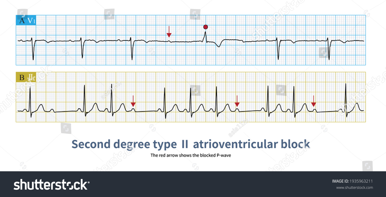 Second Degree Type Atrioventricular Block Pr Stock Illustration ...