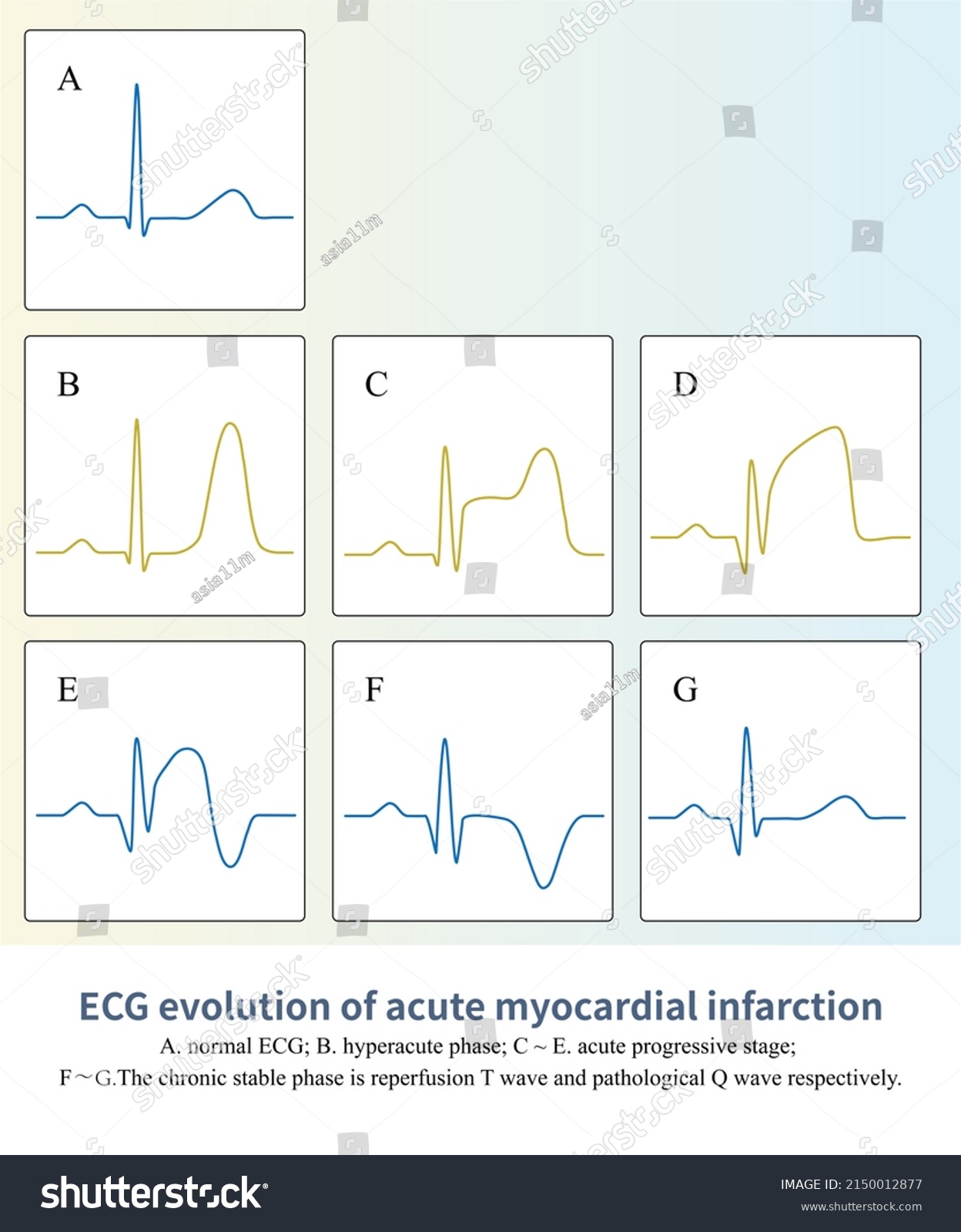 63 Pathological Q Wave 图片 库存照片和矢量图 Shutterstock