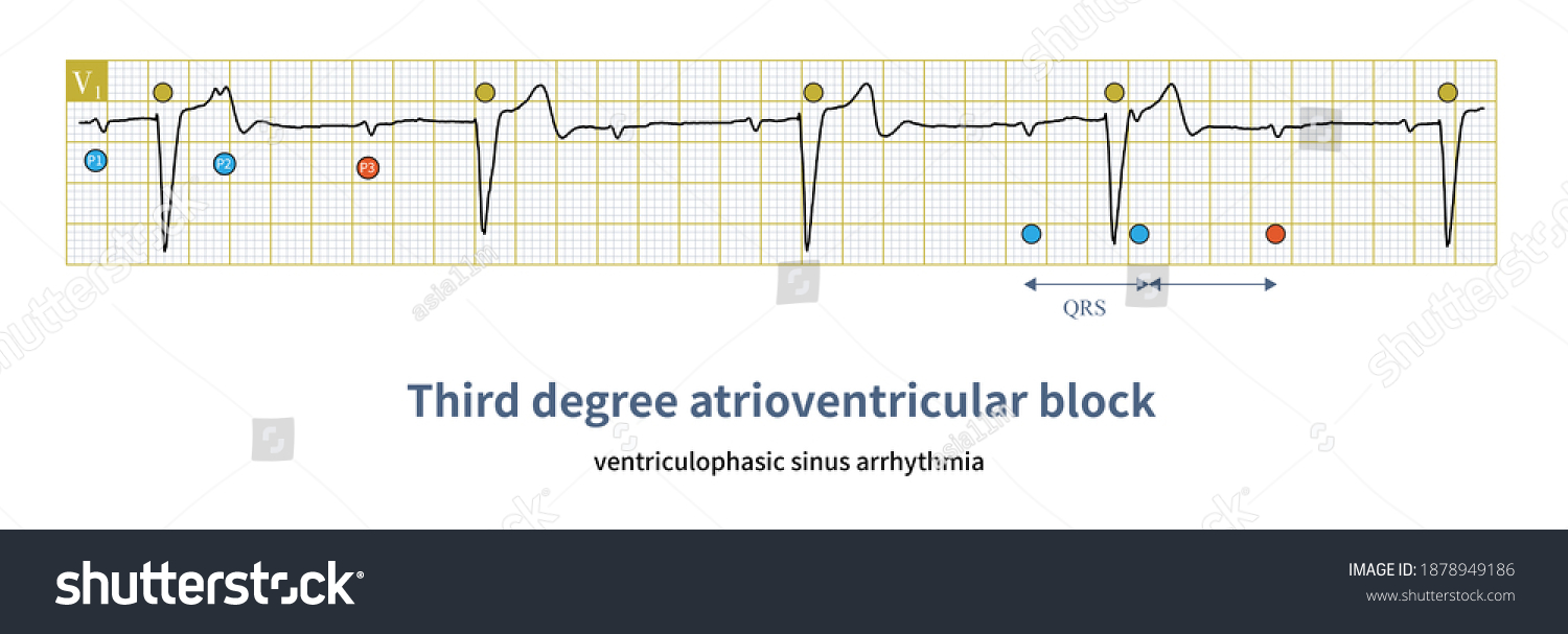 1 Ventriculophasic sinus arrhythmia Images, Stock Photos & Vectors ...