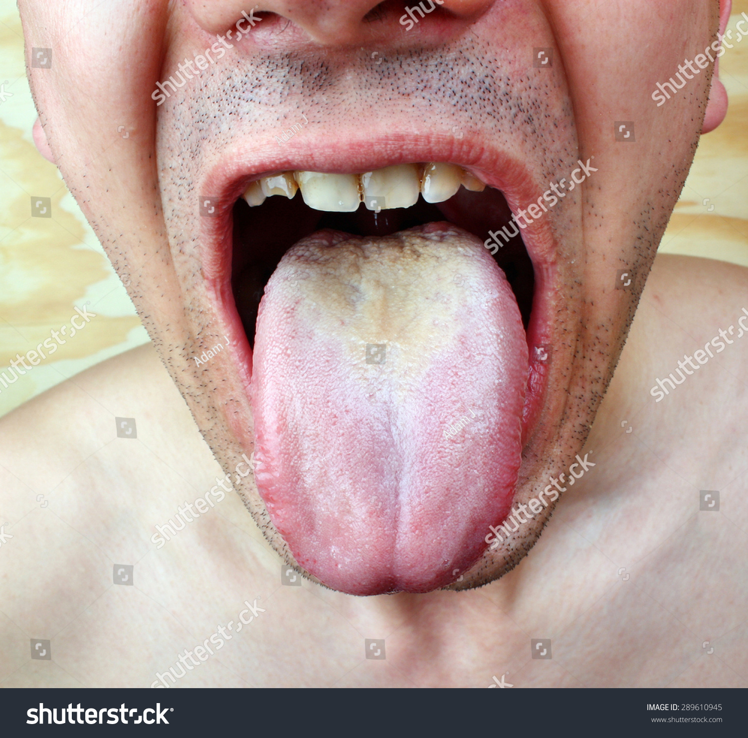 9,351 White coating tongue Images, Stock Photos & Vectors | Shutterstock