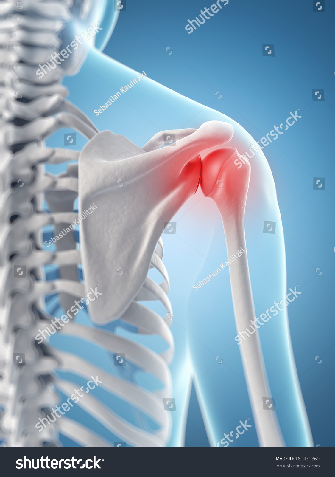 Inflamed Shoulder Joint Stock Photo 160430369 : Shutterstock