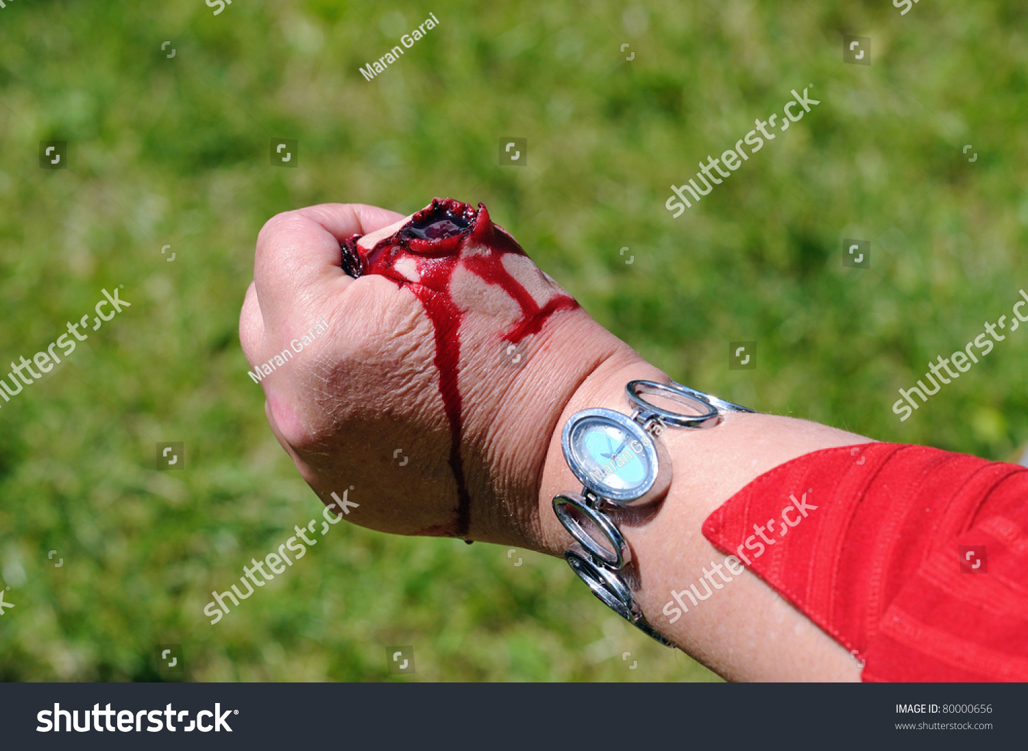 Injury Torn Off Thumb On Hand Stock Photo Edit Now