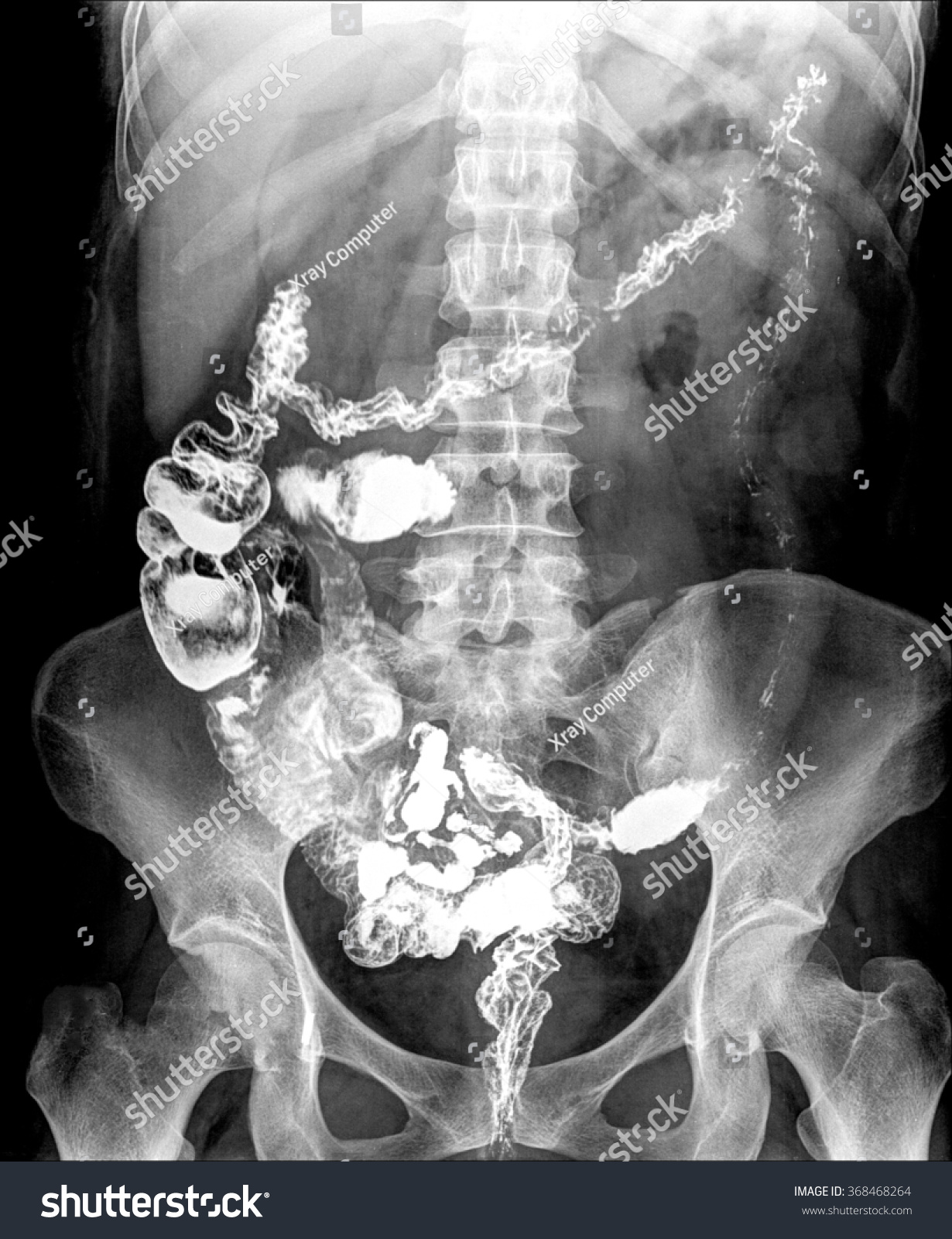 Intestine Spine Xray Stock Photo (Edit Now) 368468264