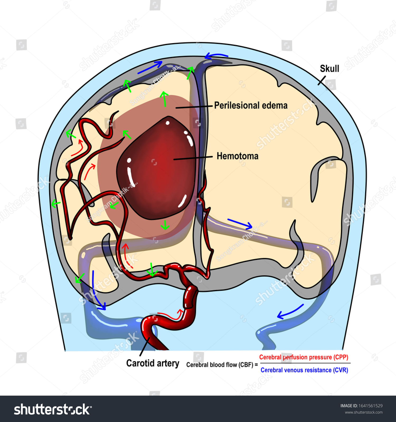 intracerebral-hemorrhage-one-disabling-stroke-hematoma-1641561529