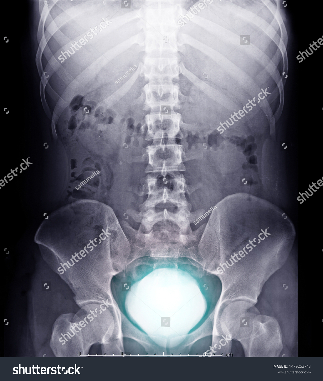 Intravenous Pyelogram Ivp Xray Exam Urinary Stock Photo 1479253748 ...