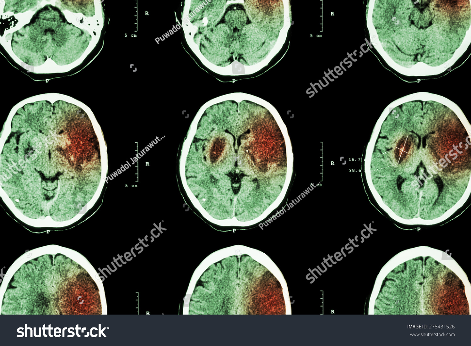 Ischemic Stroke Ct Brain Show Cerebral Stock Photo 278431526 - Shutterstock