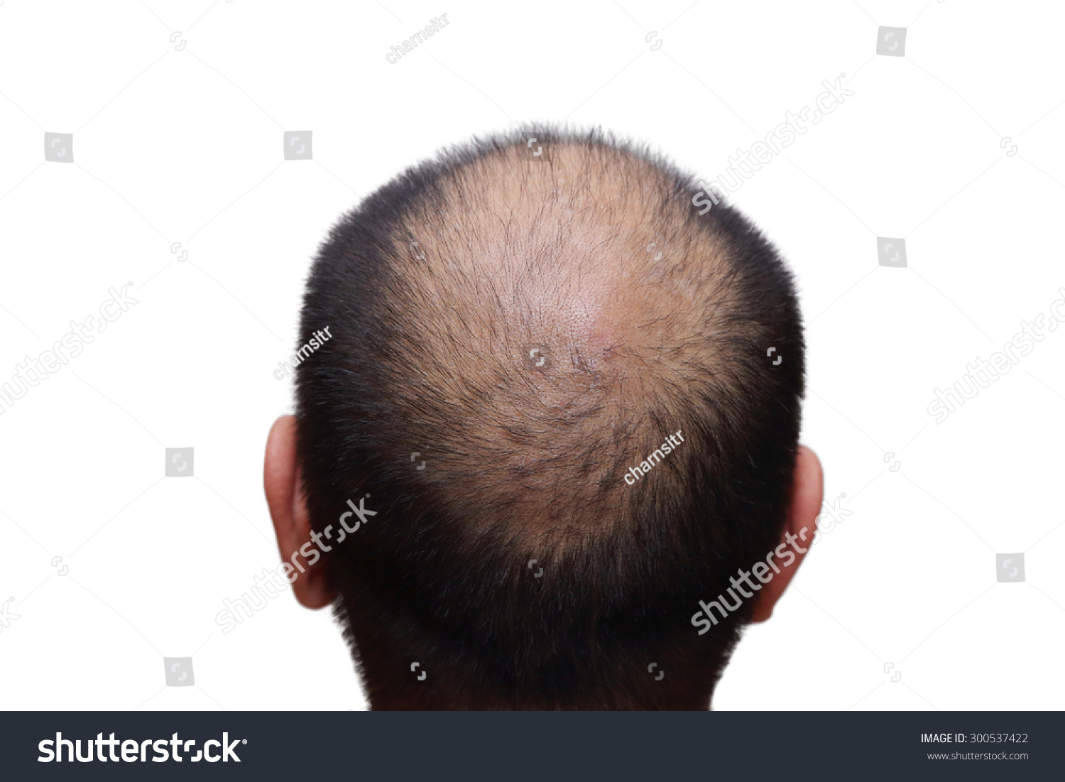 Isolated Male Hair Loss Symptoms On Stock Photo Edit Now 300537422