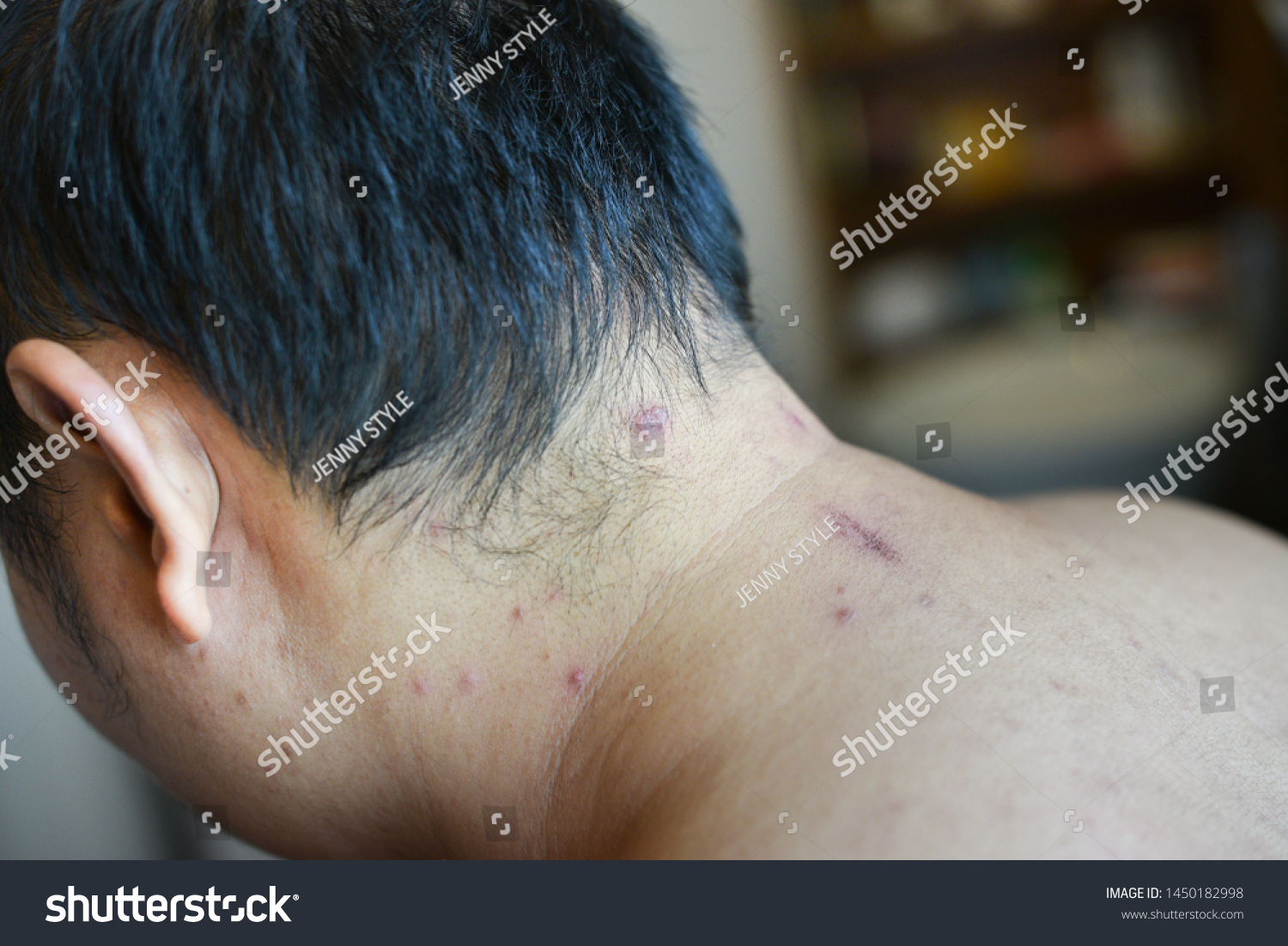 Itchy Skin Neck Look Like Eczema Stock Photo Edit Now